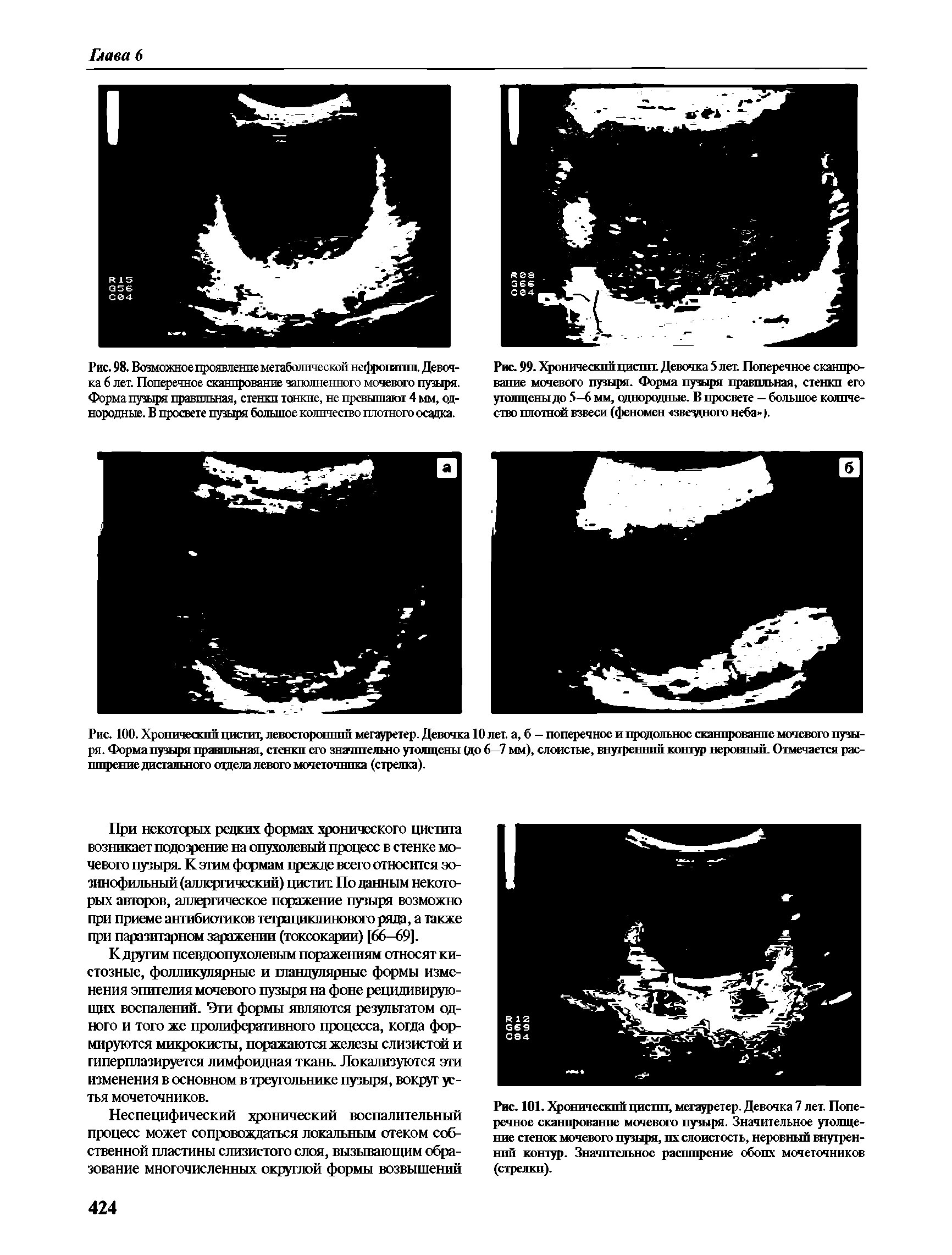 Рис. 101. Хронический цистит, мегауретер. Девочка 7 лет. Поперечное сканирование мочевого пузыря. Значительное утолщение стенок мочевого пузыря, их слоистость, неровный внутренний контур. Значительное расширение обоих мочеточников (стрелки).