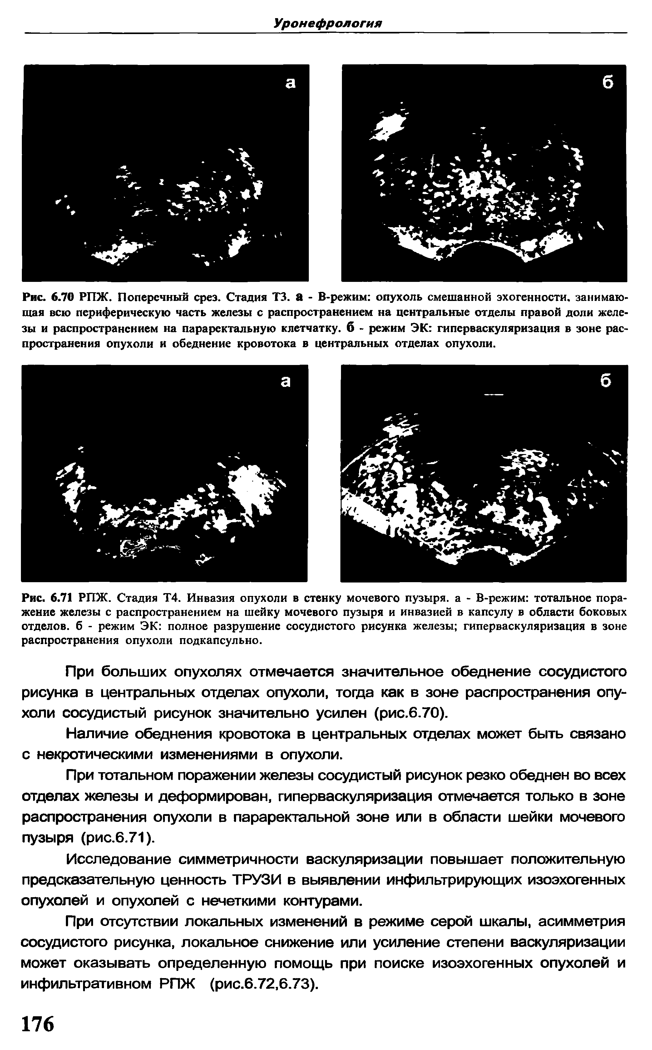 Рис. 6.70 РПЖ. Поперечный срез. Стадия ТЗ. а - В-режим опухоль смешанной эхогенности, занимающая всю периферическую часть железы с распространением на центральные отделы правой доли железы и распространением на параректальную клетчатку, б - режим ЭК гиперваскуляризация в зоне распространения опухоли и обеднение кровотока в центральных отделах опухоли.