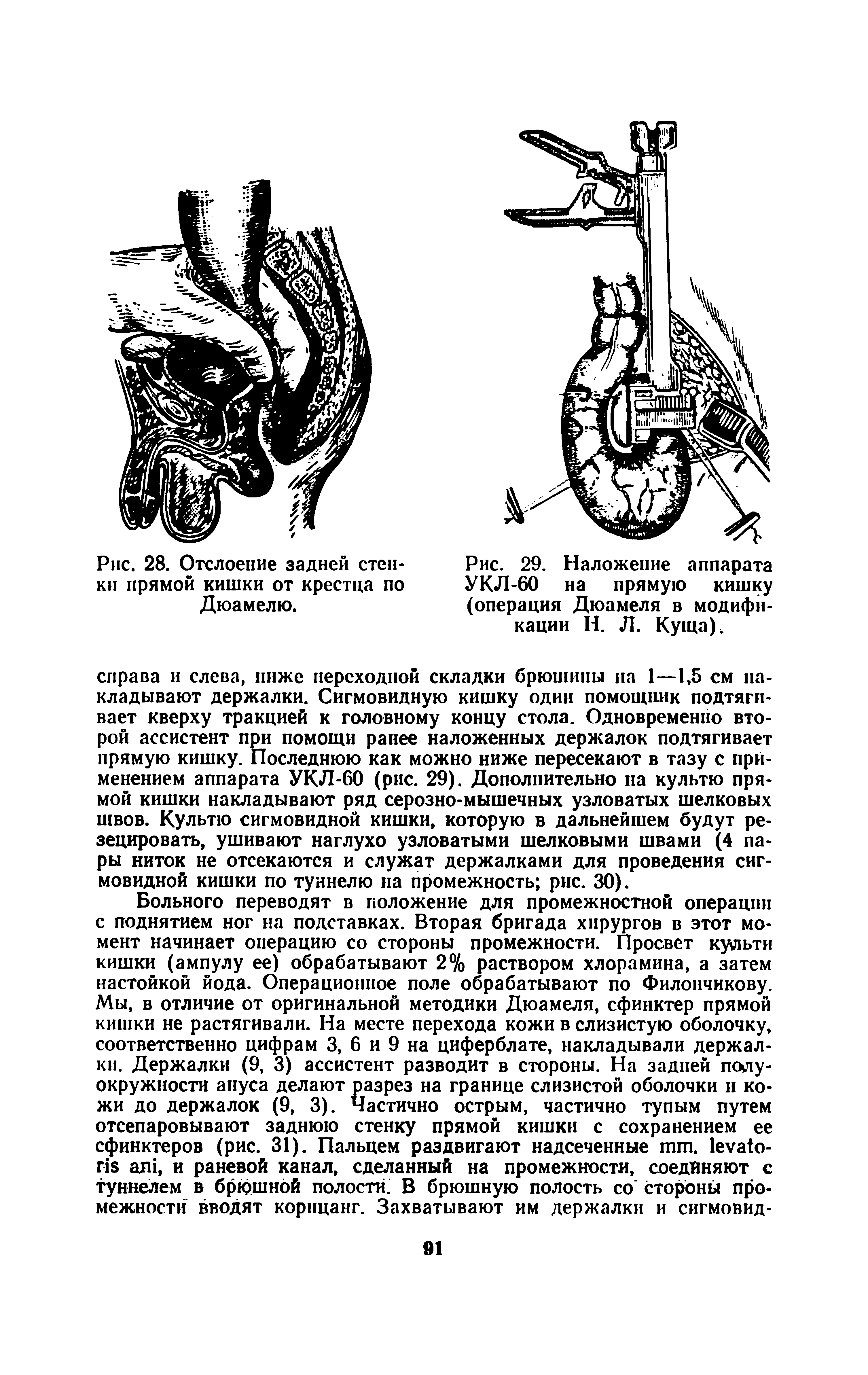 Рис. 29. Наложение аппарата УКЛ-60 на прямую кишку (операция Дюамеля в модификации Н. Л. Куща).