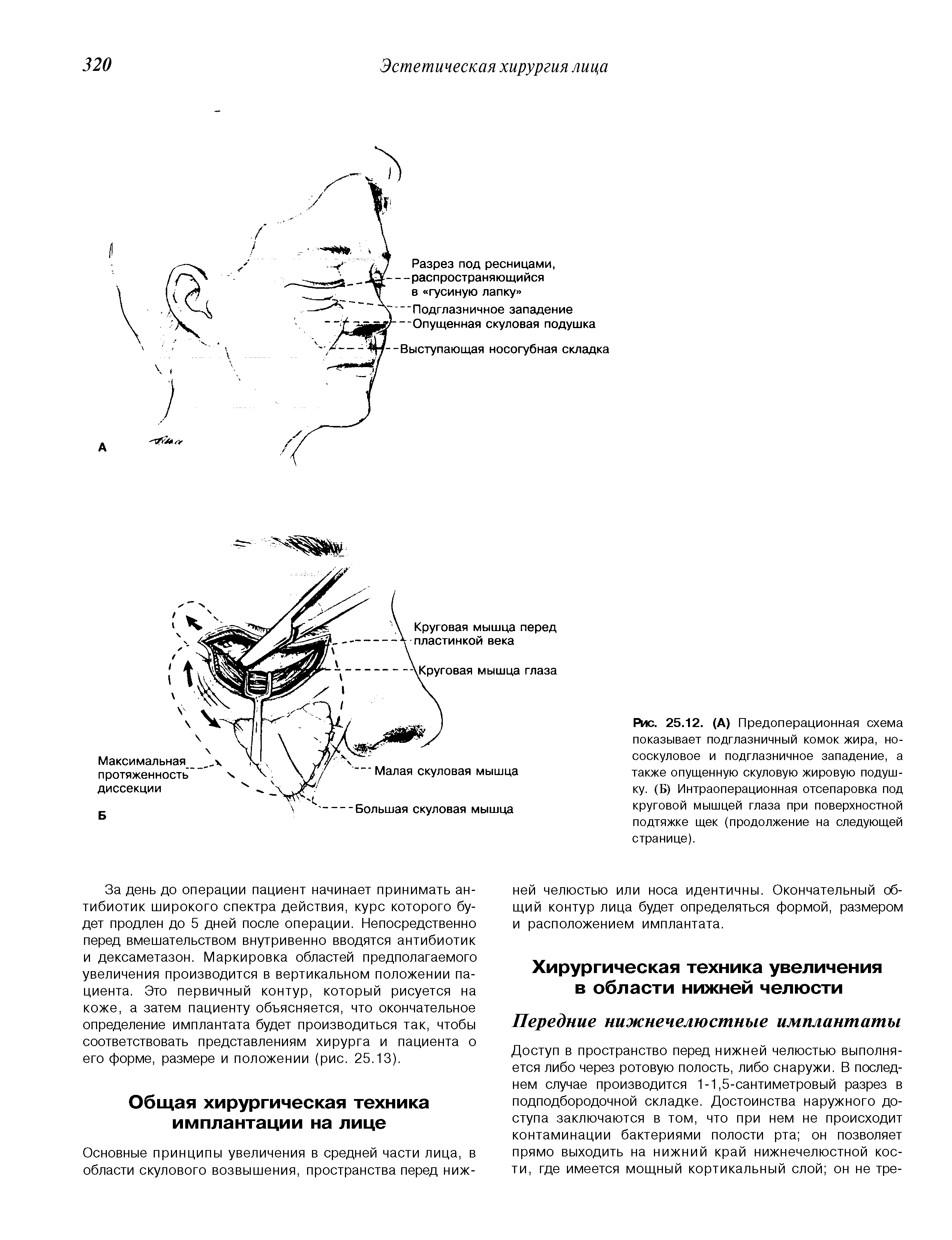 Рис. 25.12. (А) Предоперационная схема показывает подглазничный комок жира, нососкуловое и подглазничное западение, а также опущенную скуловую жировую подушку. (Б) Интраоперационная отсепаровка под круговой мышцей глаза при поверхностной подтяжке щек (продолжение на следующей странице).