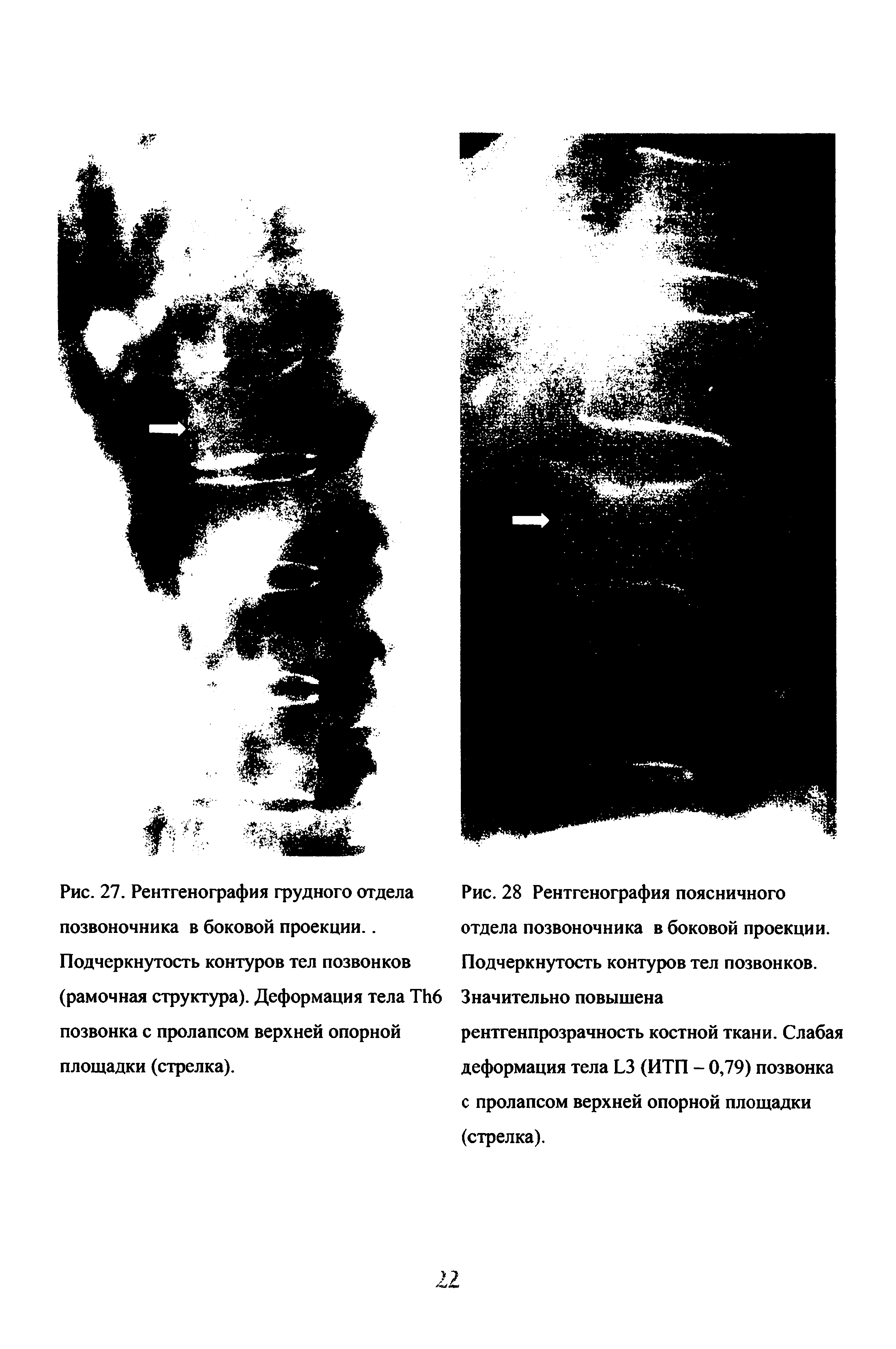 Рис. 27. Рентгенография грудного отдела позвоночника в боковой проекции.. Подчеркнутость контуров тел позвонков (рамочная структура). Деформация тела ТИ6 позвонка с пролапсом верхней опорной площадки (стрелка).
