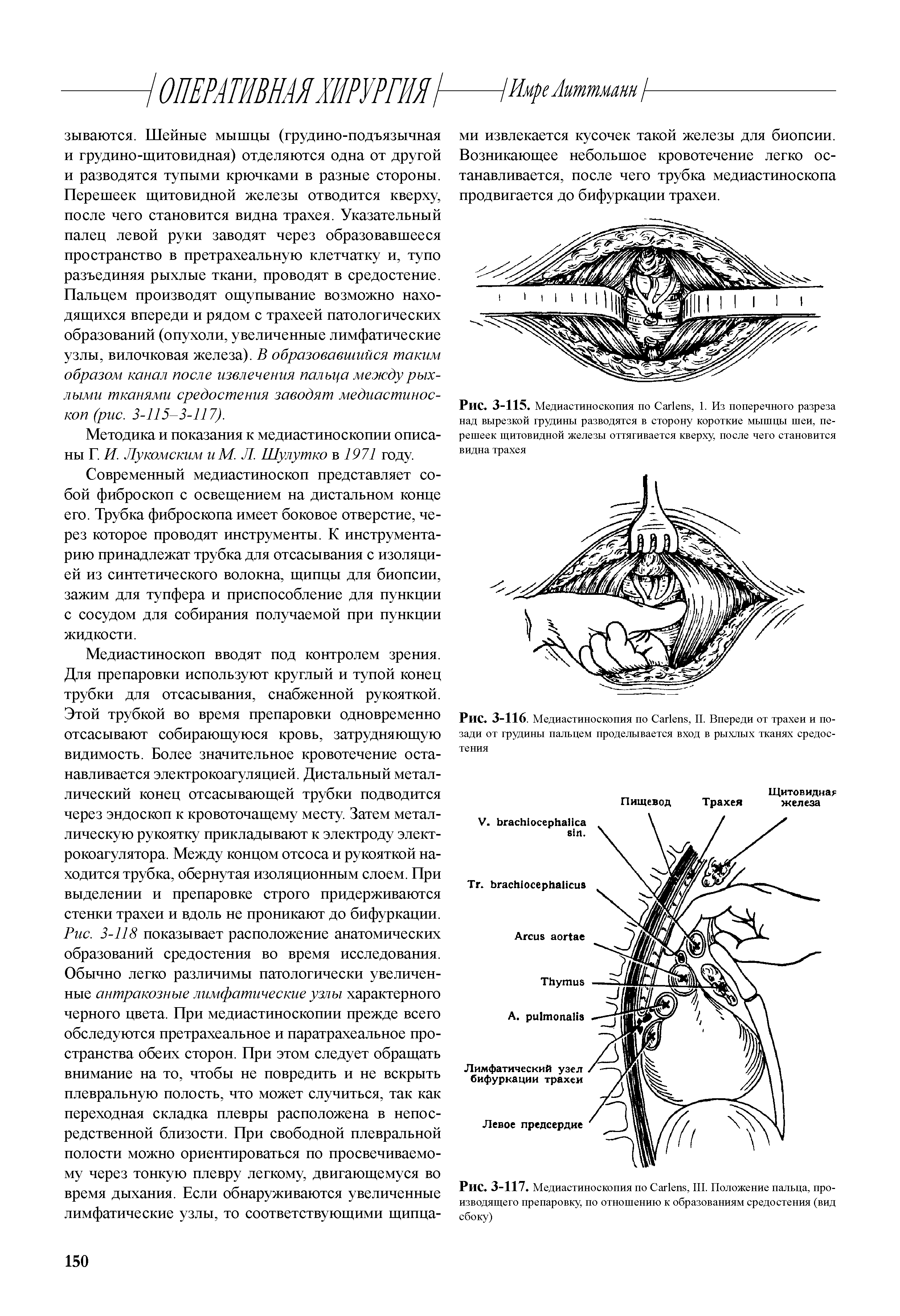 Рис. 3-115. Медиастиноскопия по Саг1епБ, 1. Из поперечного разреза над вырезкой грудины разводятся в сторону короткие мышцы шеи, перешеек щитовидной железы оттягивается кверху, после чего становится видна трахея...
