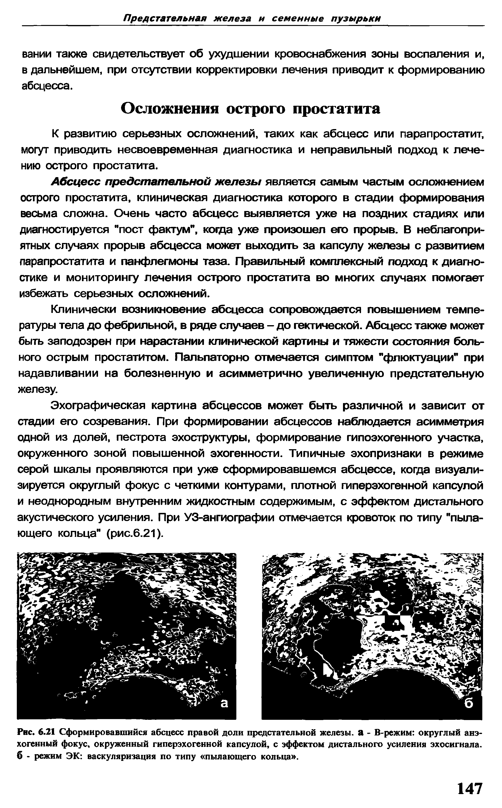 Рис. 6.21 Сформировавшийся абсцесс правой доли предстательной железы, а - В-режим округлый анэ-хогенный фокус, окруженный гиперэхогенной капсулой, с эффектом дистального усиления эхосигнала. б - режим ЭК васкуляризация по типу пылающего кольца .