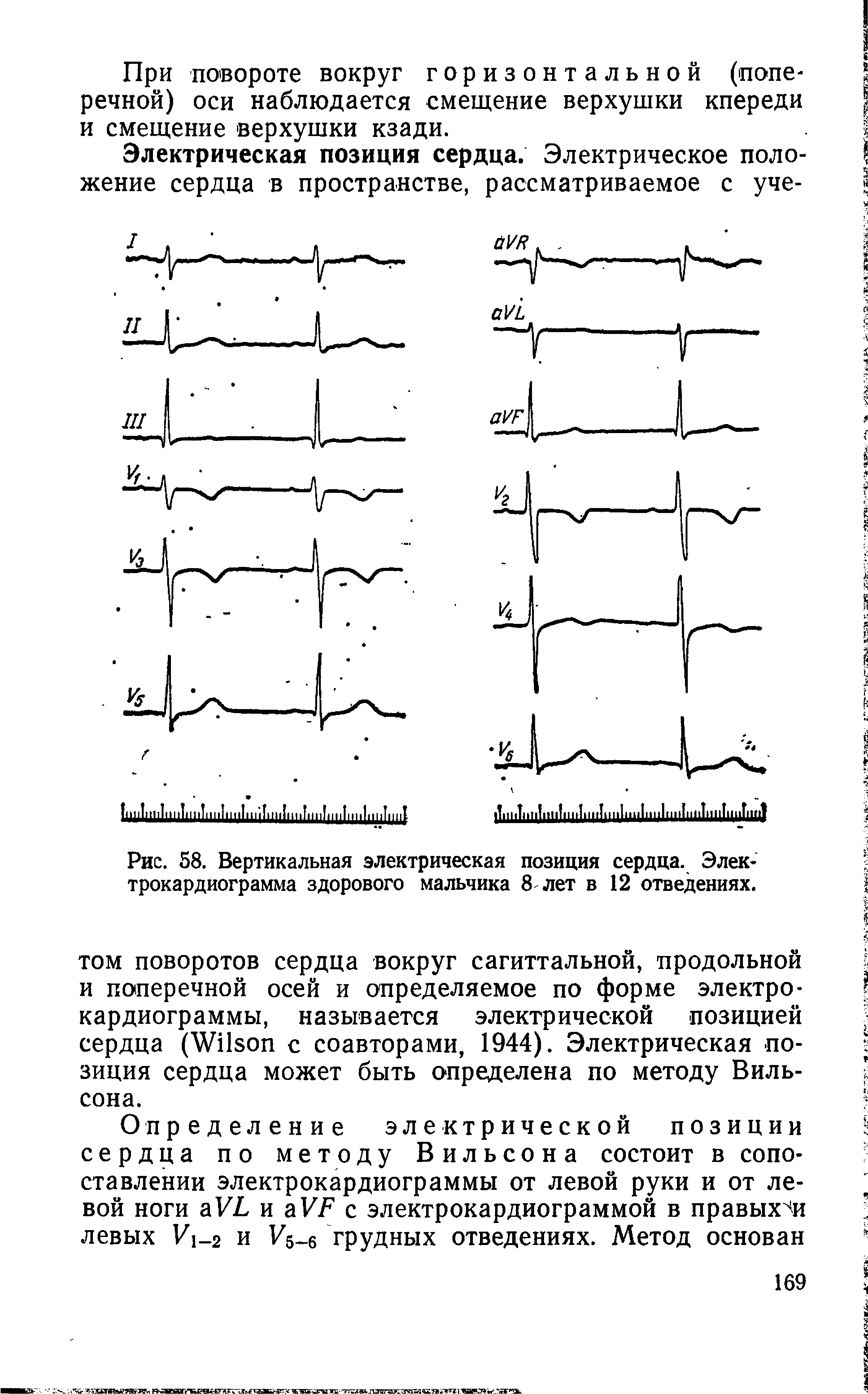 Рис. 58. Вертикальная электрическая позиция сердца. Электрокардиограмма здорового мальчика 8 лет в 12 отведениях.