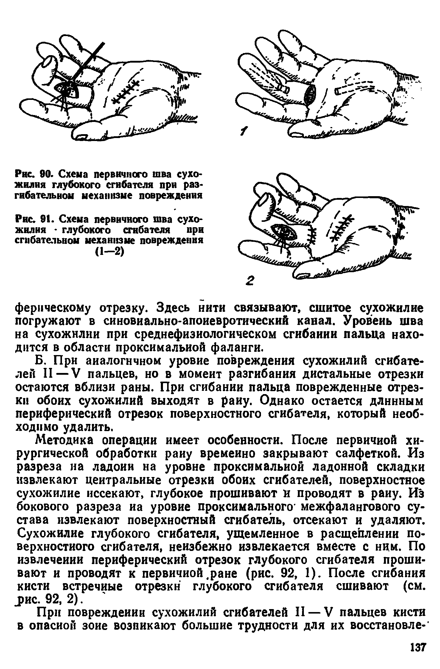 Рис. 91. Схема первичного шва сухожилия глубокого сгибателя при сгибательном механизме повреждения (1-2)...