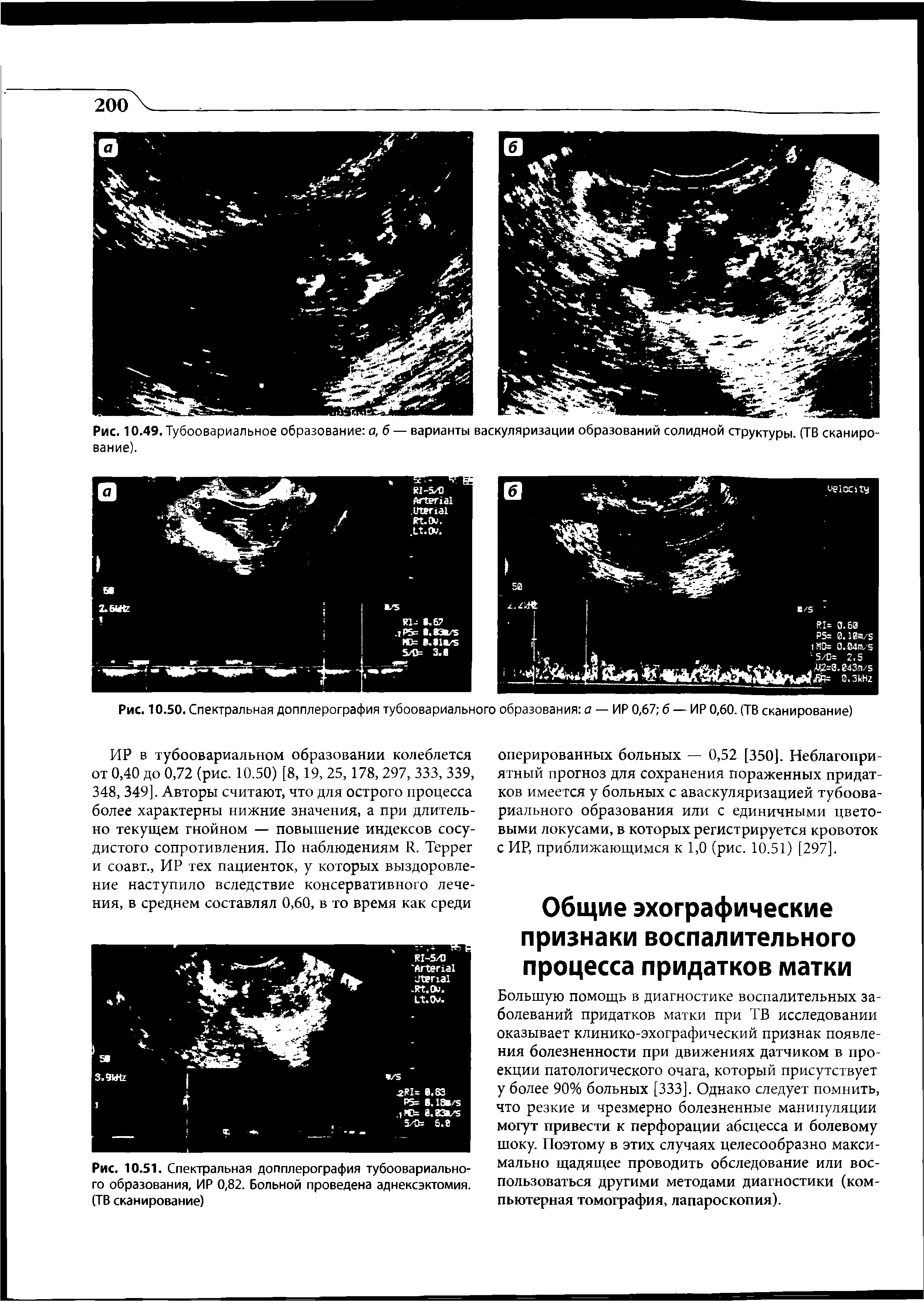 Рис. 10.51. Спектральная допплерография тубоовариального образования, ИР 0,82. Больной проведена аднексэктомия. (ТВ сканирование)...