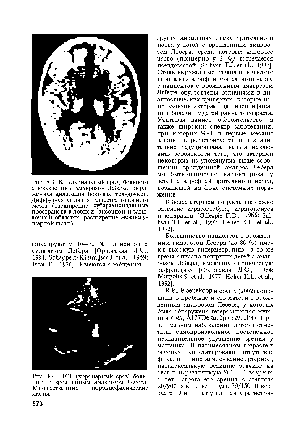 Рис. 8.4. НСГ (коронарный срез) больного с врожденным амаврозом Лебера. Множественные порэнцефалические кисты.