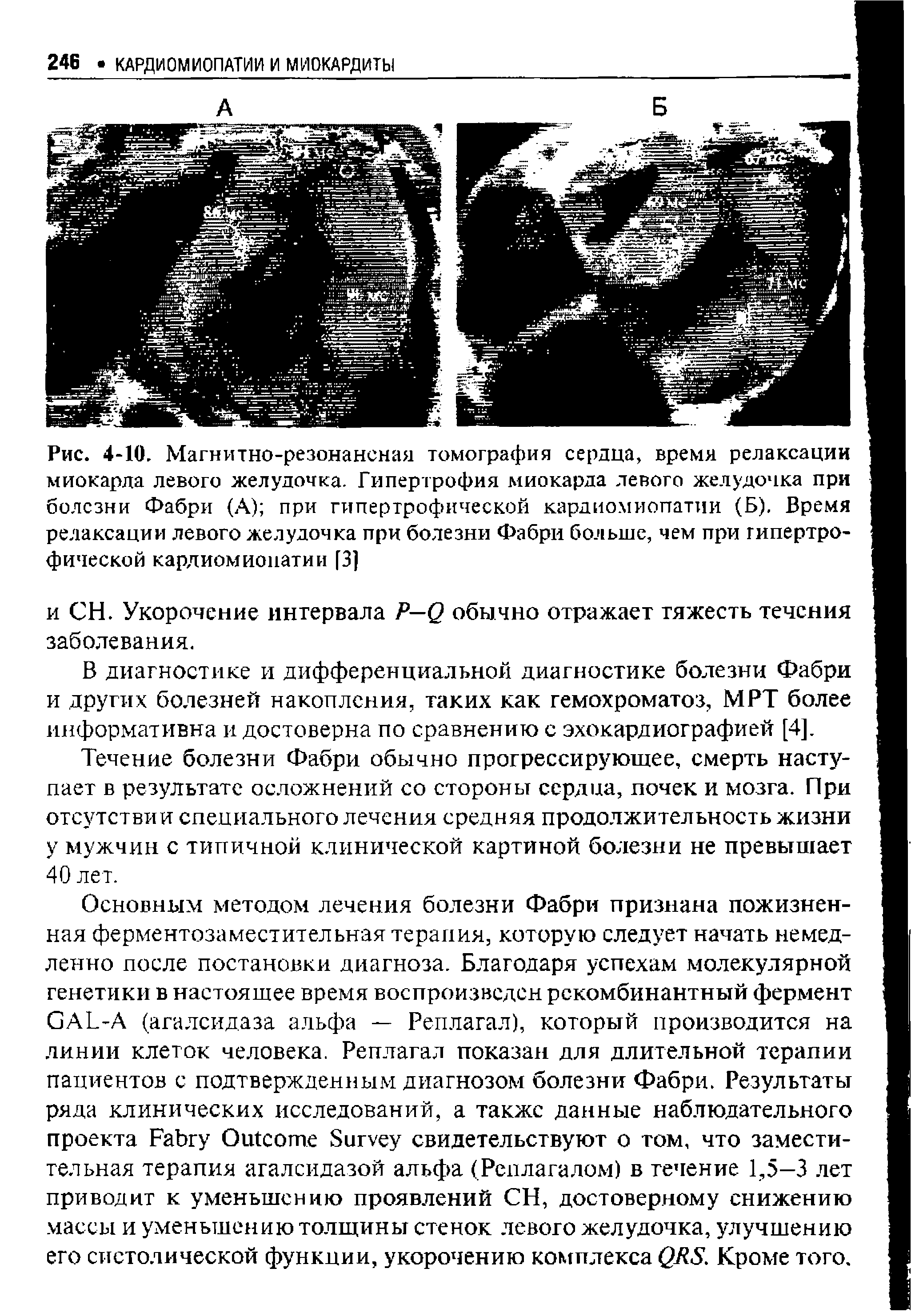 Рис. 4-10. Магнитно-резонансная томография сердца, время релаксации миокарда левого желудочка. Гипертрофия миокарда левого желудочка при болезни Фабри (А) при гипертрофической кардиомиопатии (Б). Время релаксации левого желудочка при болезни Фабри больше, чем при гипертрофической кардиомиопатии [3]...