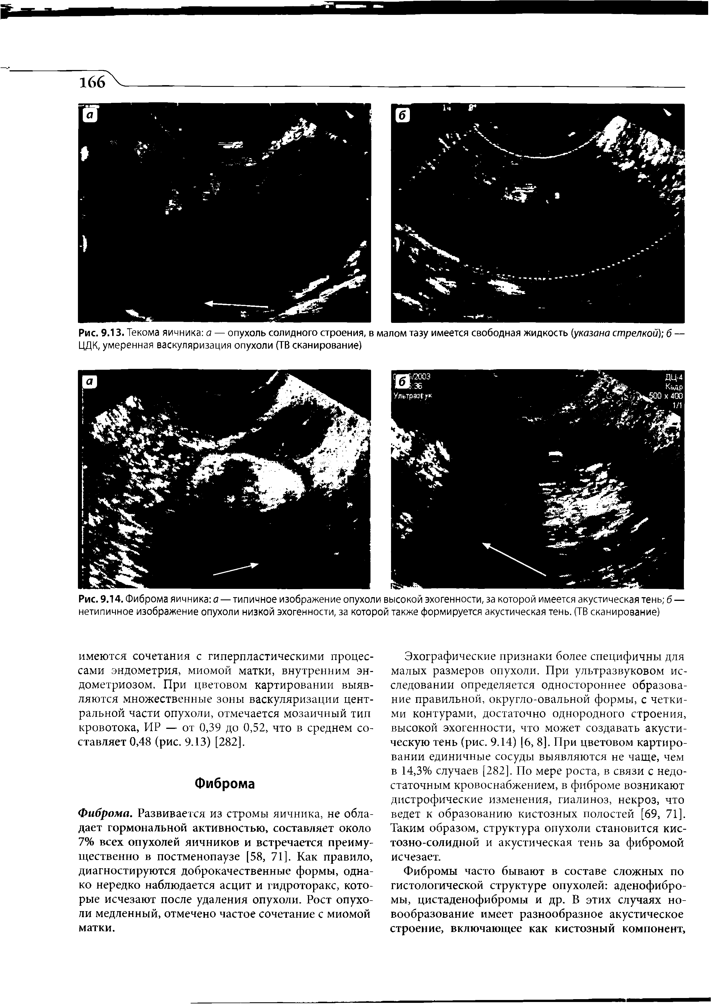 Рис. 9.14. Фиброма яичника а — типичное изображение опухоли высокой эхогенности, за которой имеется акустическая тень б — нетипичное изображение опухоли низкой эхогенности, за которой также формируется акустическая тень. (ТВ сканирование)...