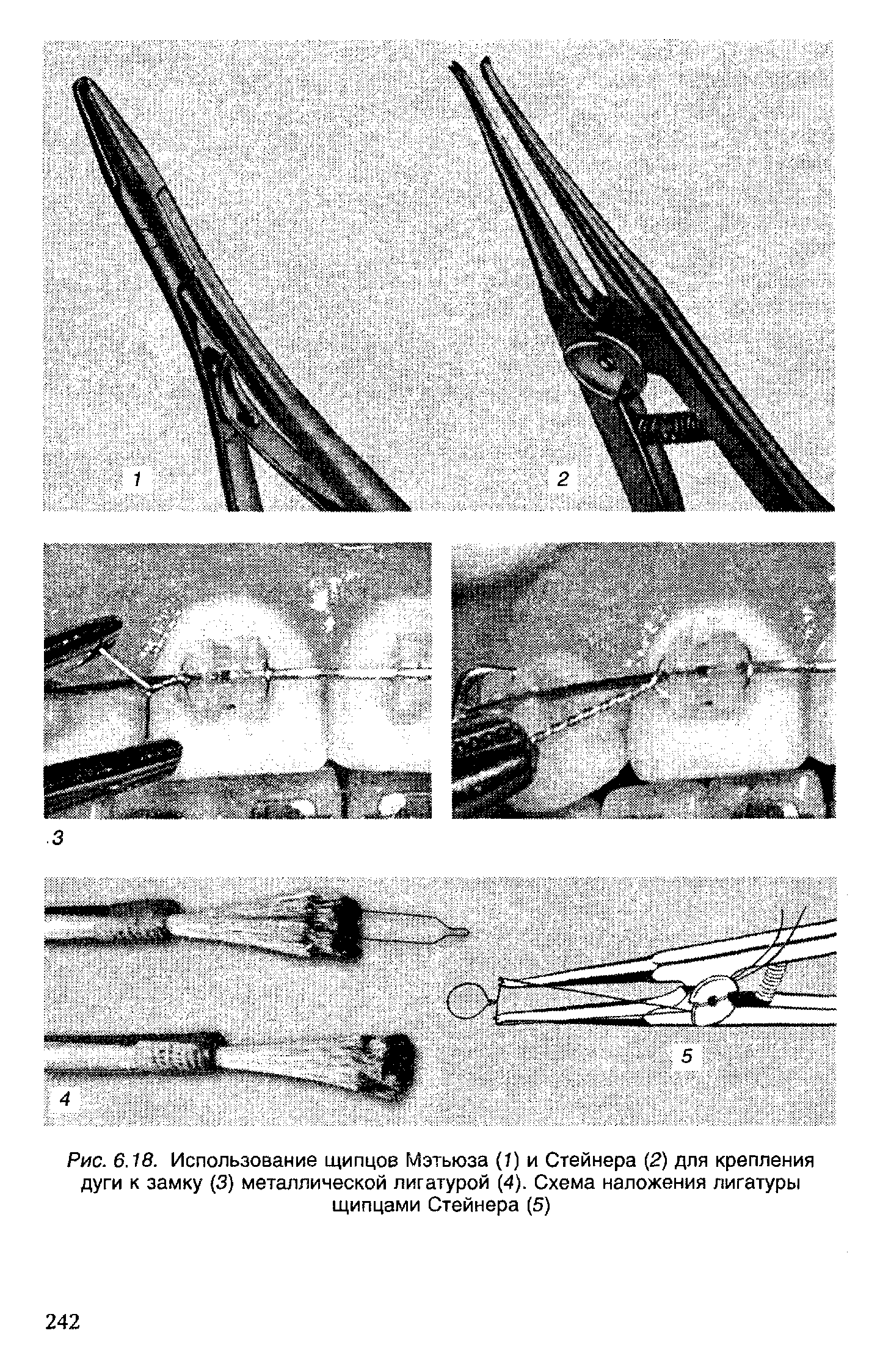 Рис. 6.18. Использование щипцов Мэтьюза (Т) и Стейнера (2) для крепления дуги к замку (3) металлической лигатурой (4). Схема наложения лигатуры щипцами Стейнера (5)...