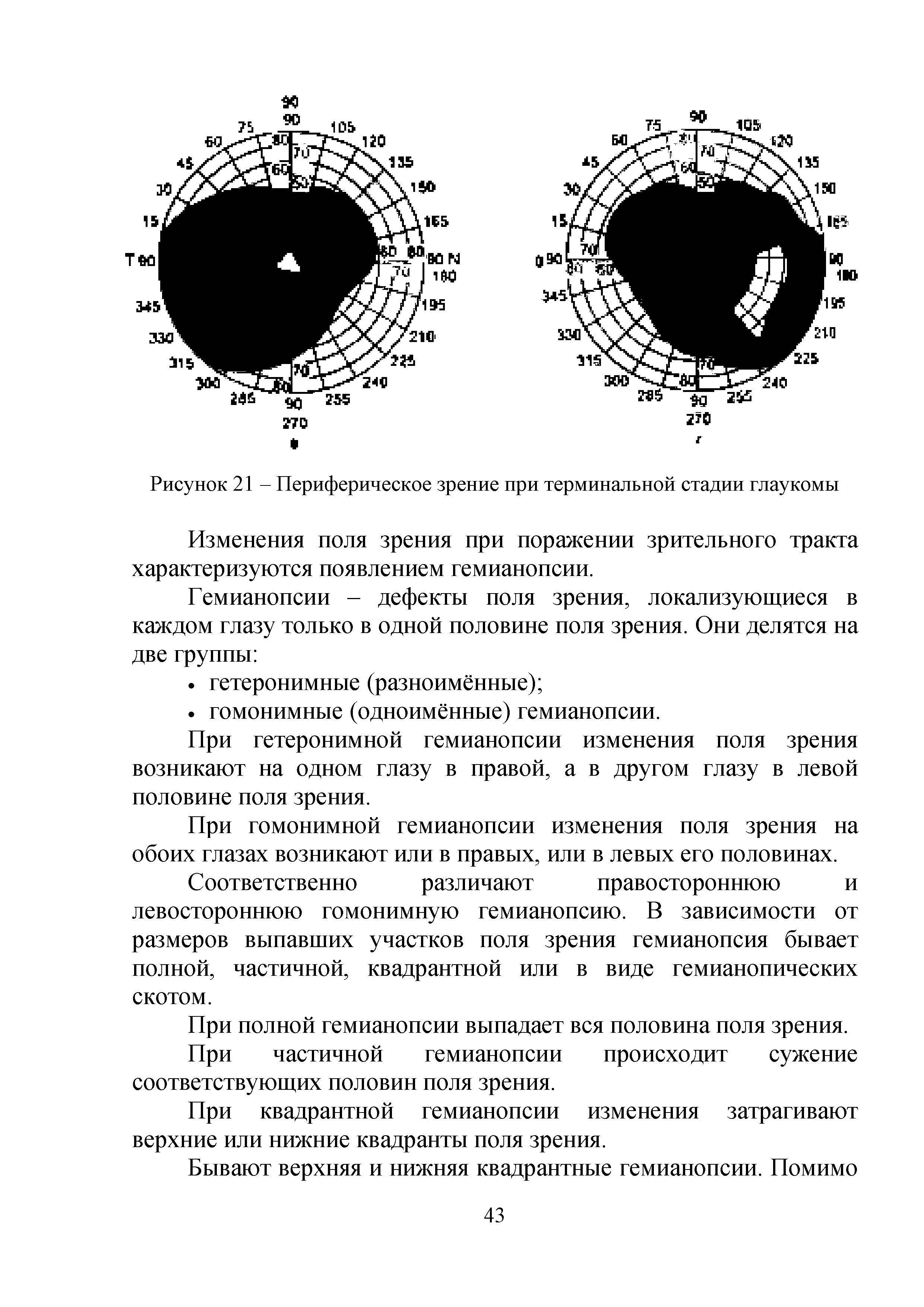 Рисунок 21 - Периферическое зрение при терминальной стадии глаукомы...