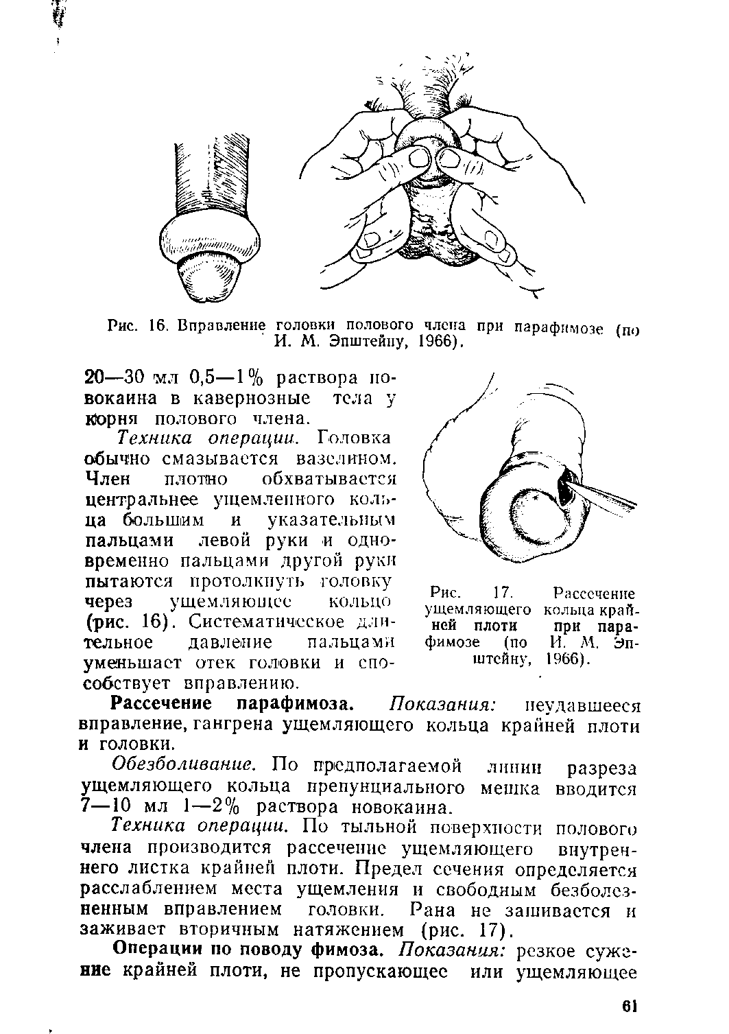 Рис. 16. Вправление головки полового члена при парафимозе (по И. М. Эпштейну, 1966).
