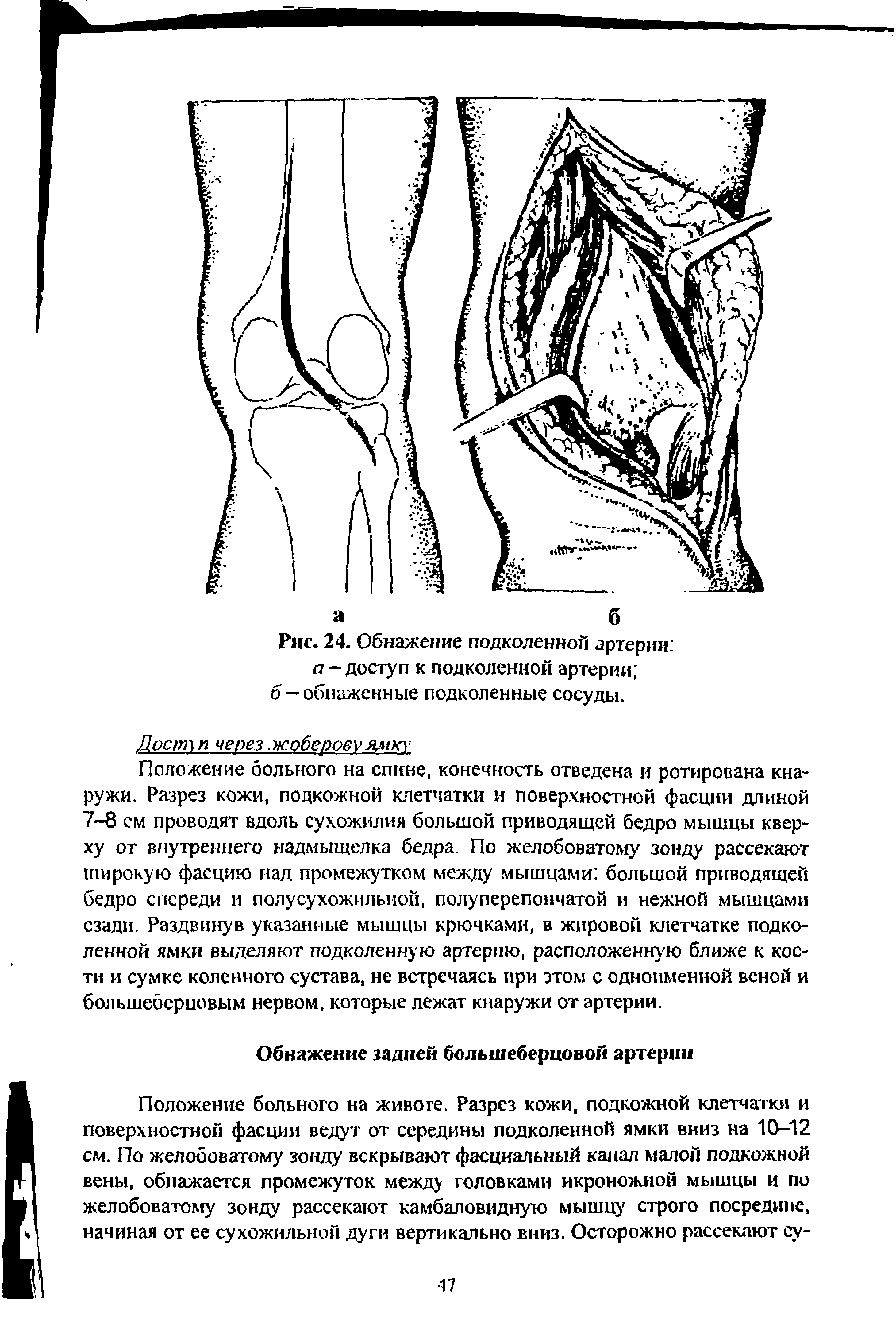 Рис. 24. Обнажение подколенной артерии а - доступ к подколенной артерии ...