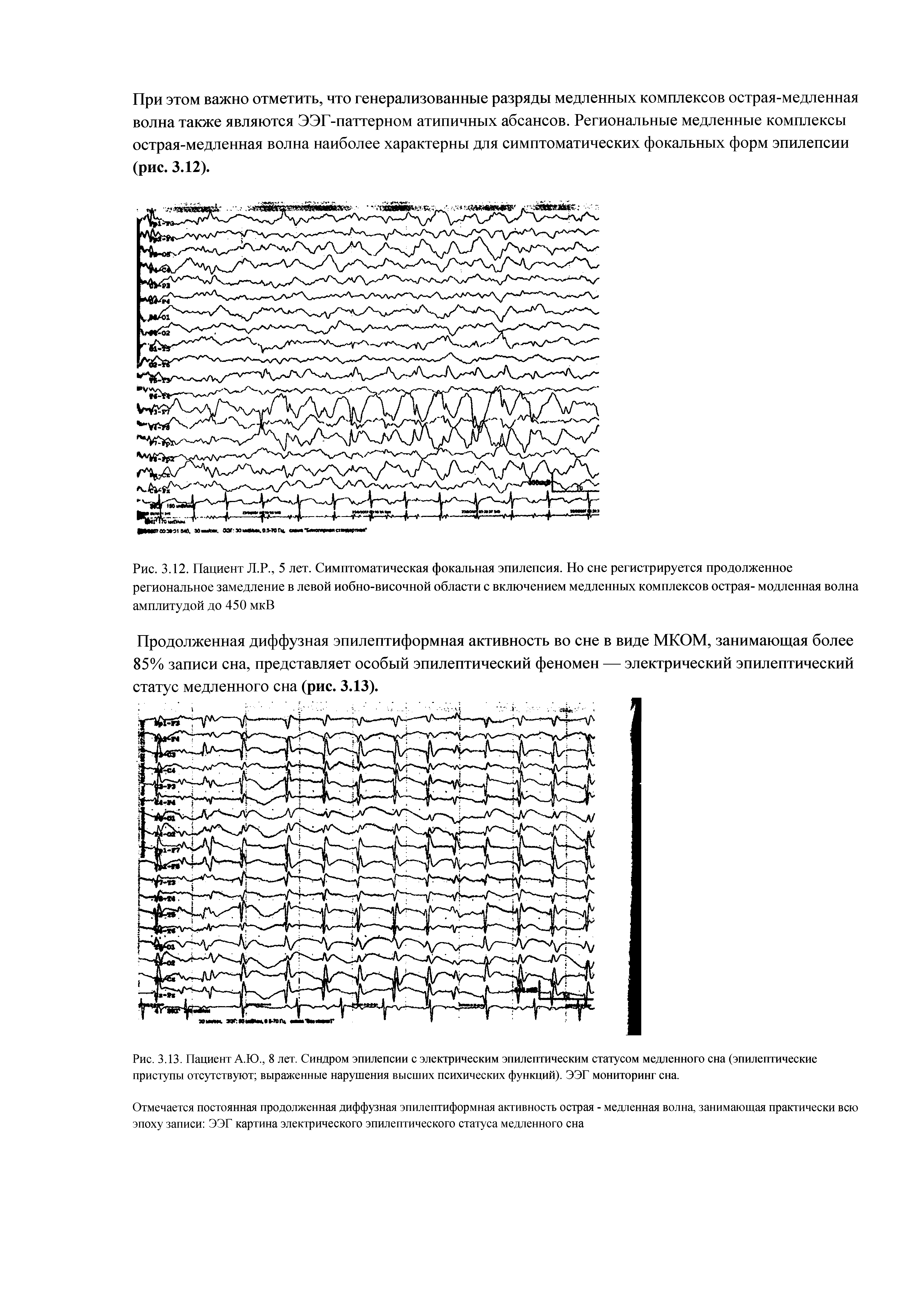Рис. 3.12. Пациент Л.Р., 5 лет. Симптоматическая фокальная эпилепсия. Но сне регистрируется продолженное региональное замедление в левой иобно-височной области с включением медленных комплексов острая- модленная волна амплитудой до 450 мкВ...