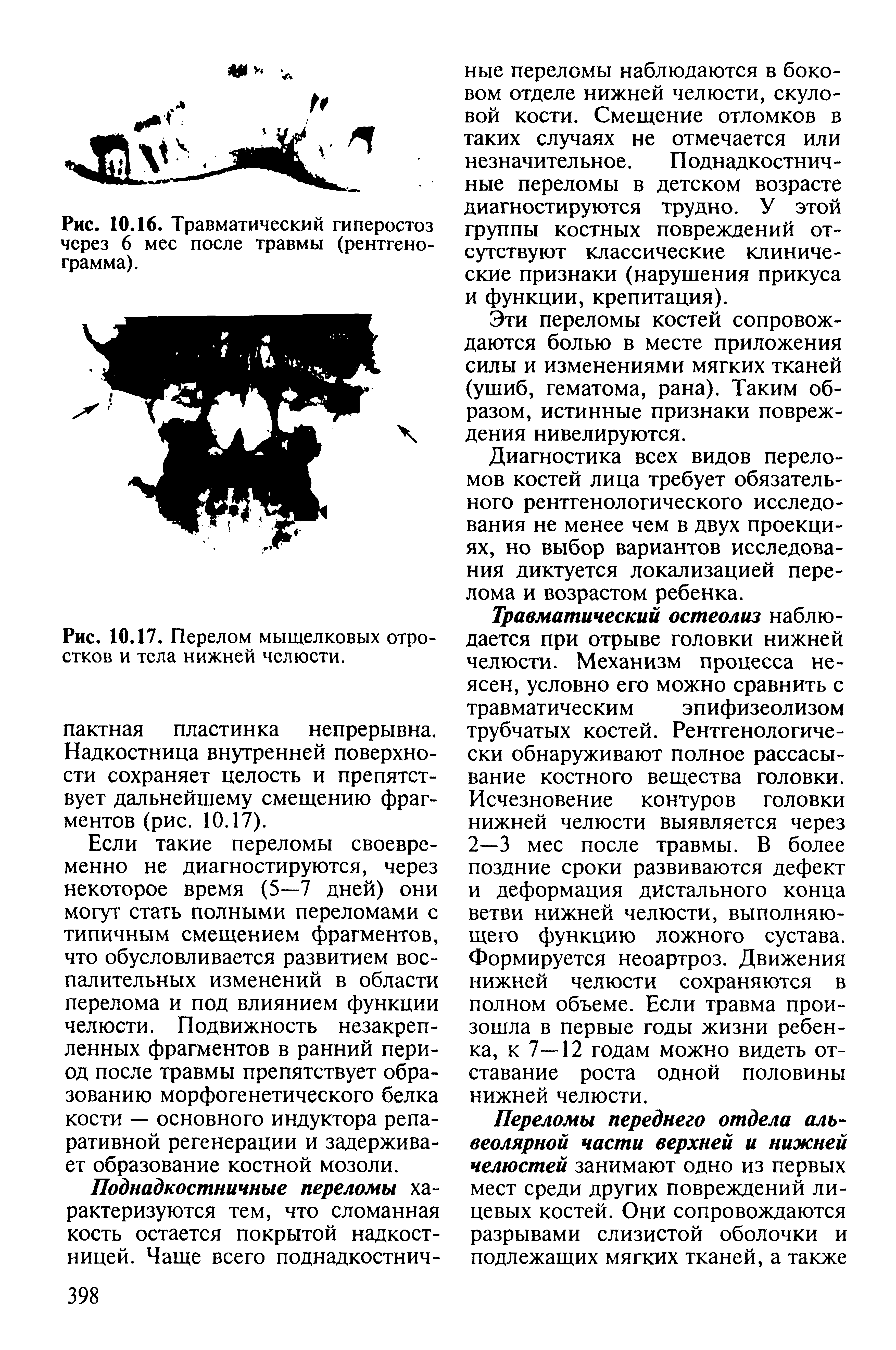 Рис. 10.17. Перелом мыщелковых отростков и тела нижней челюсти.