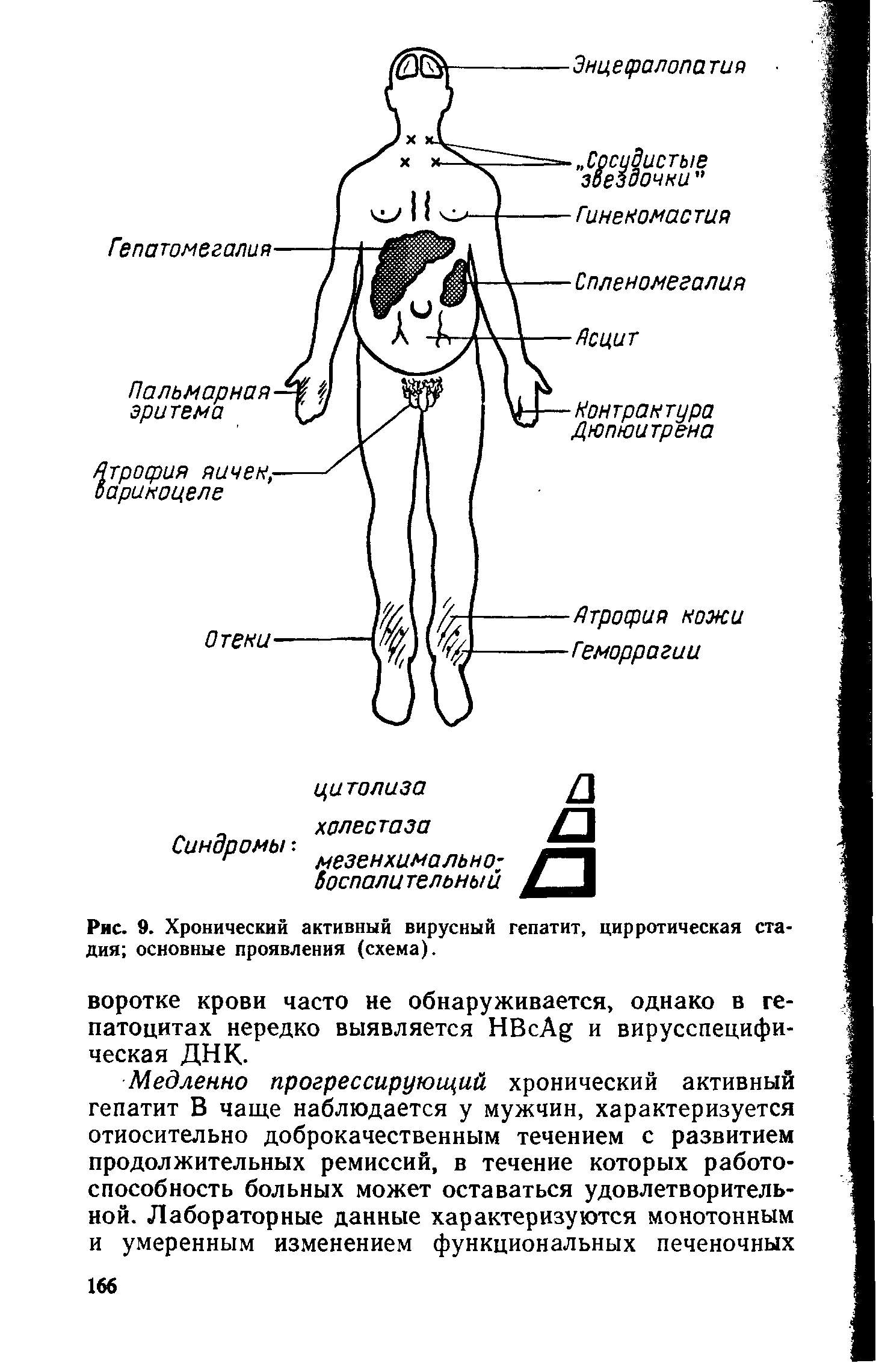 Рис. 9. Хронический активный вирусный гепатит, цирротическая стадия основные проявления (схема).