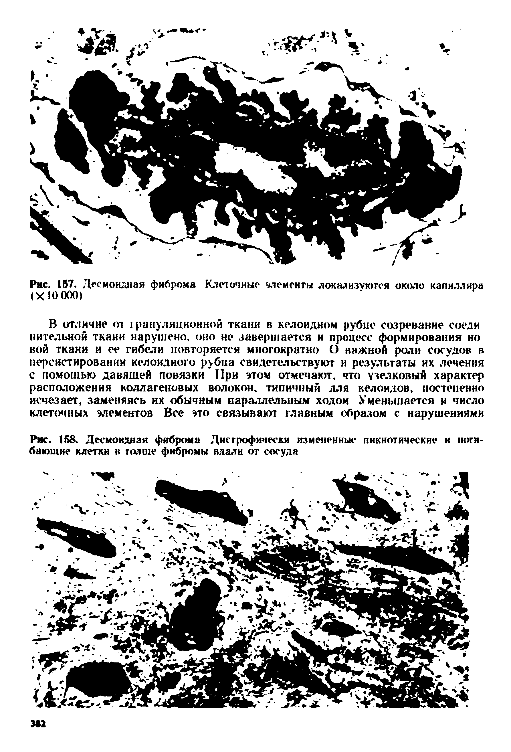 Рис. 158. Десмоидная фиброма Дистрофически измененные пикнотические и погибающие клетки в толще фибромы вдали от сосуда...