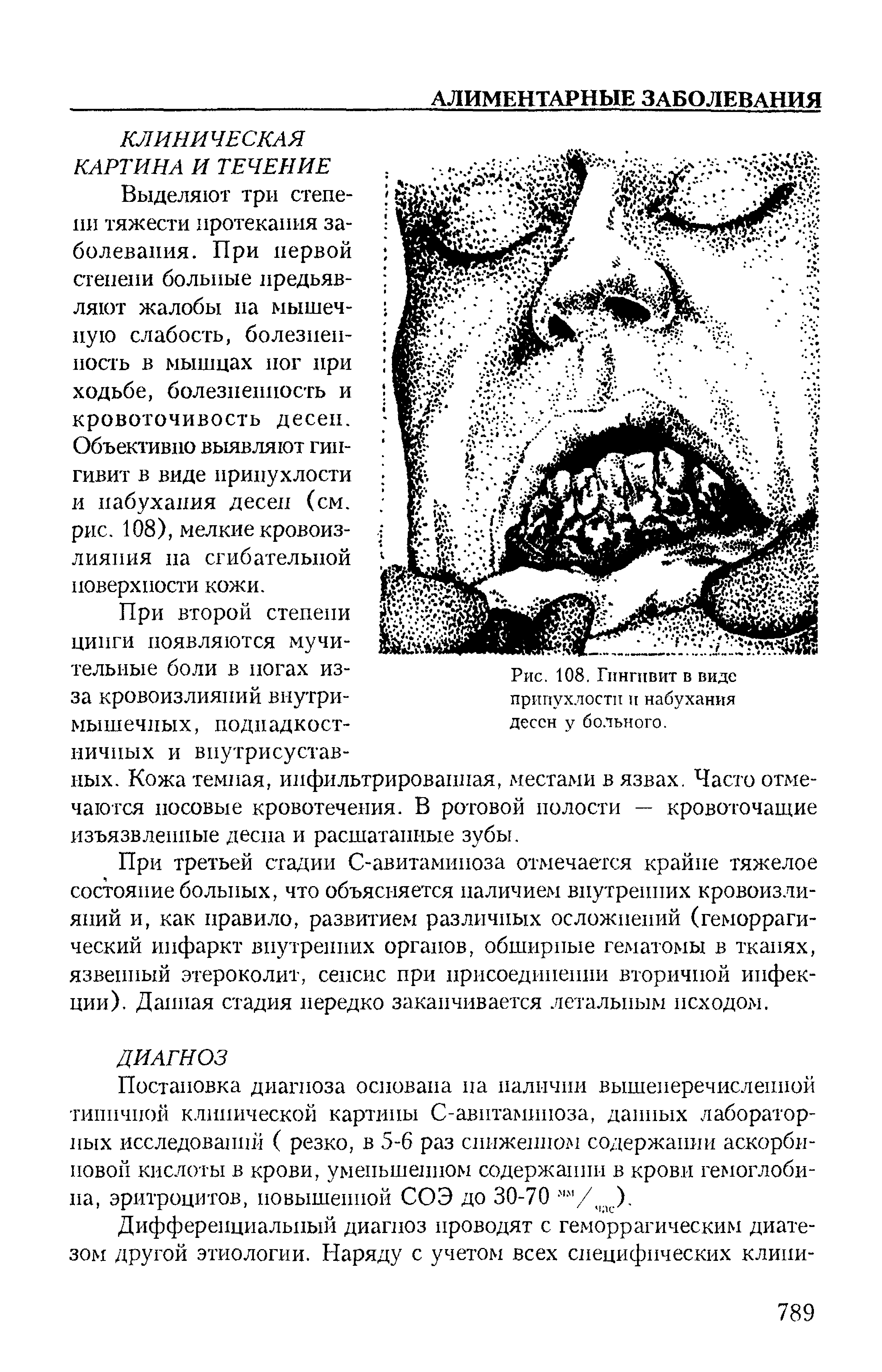 Рис. 108. Гингивит в виде припухлости и набухания десен у больного.