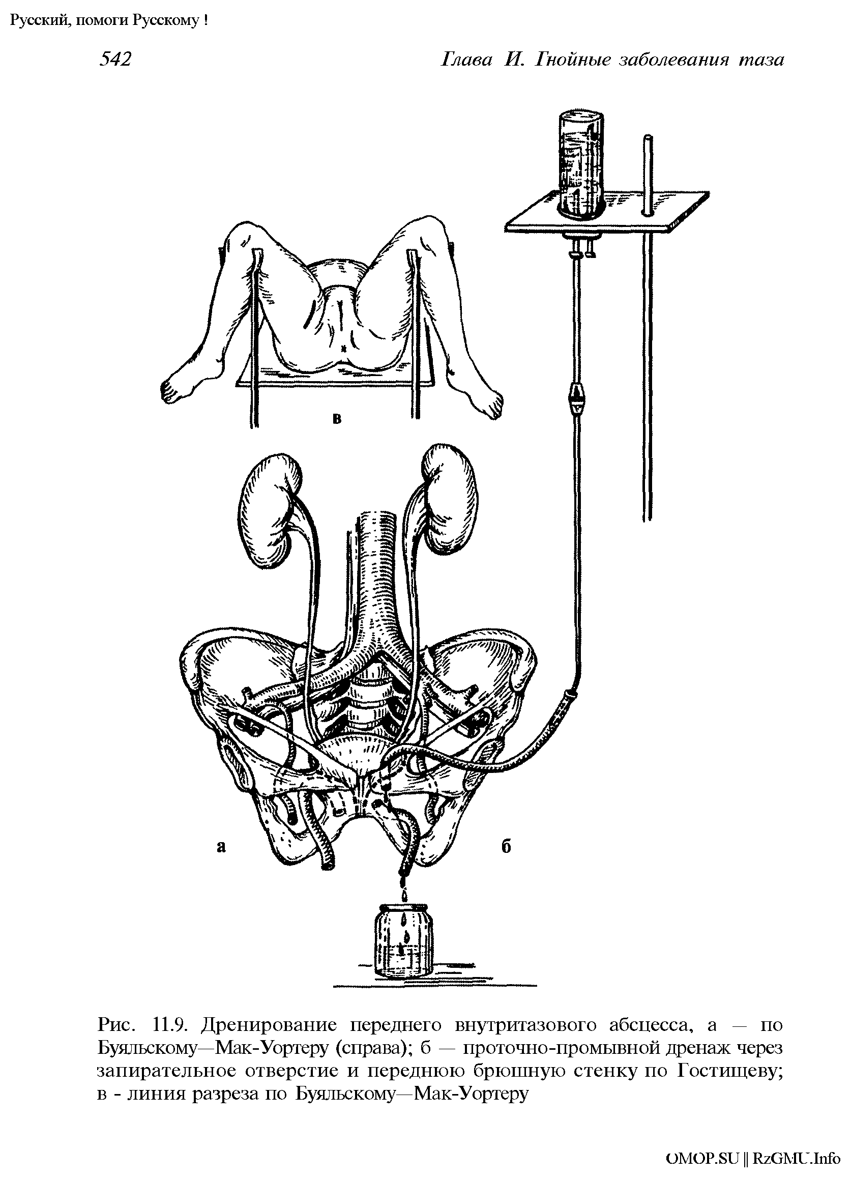 Рис. 11.9. Дренирование переднего внутритазового абсцесса, а — по Буяльскому—Мак-Уортеру (справа) б — проточно-промывной дренаж через запирательное отверстие и переднюю брюшную стенку по Гостигцеву в - линия разреза по Буяльскому—Мак-Уортеру...