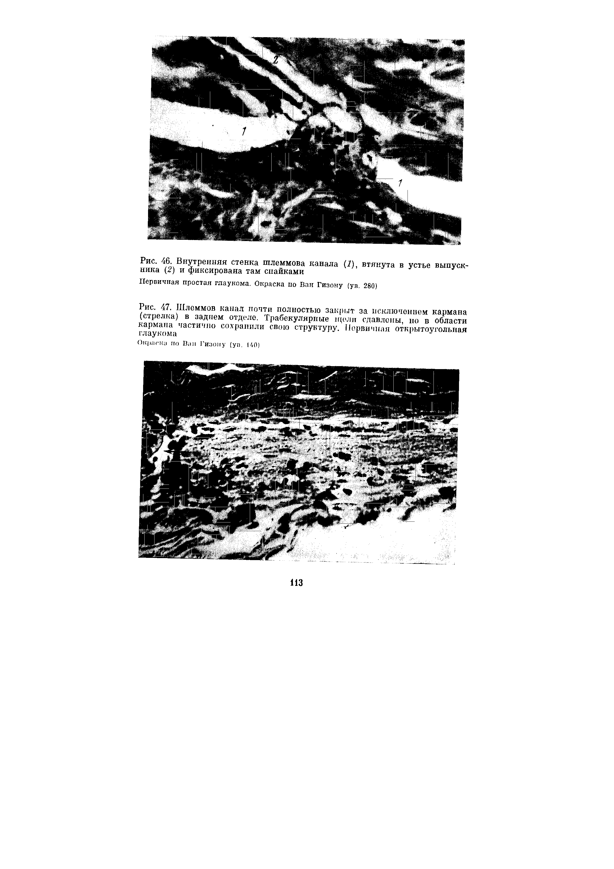 Рис. 47. Шлеммов канал почти полностью закрыт за исключением кармана (стрелка) в заднем отделе. Трабекулярные принт сдавлены, но в области кармана частично сохранили свою структуру. Первичная открытоугольная глаукома...