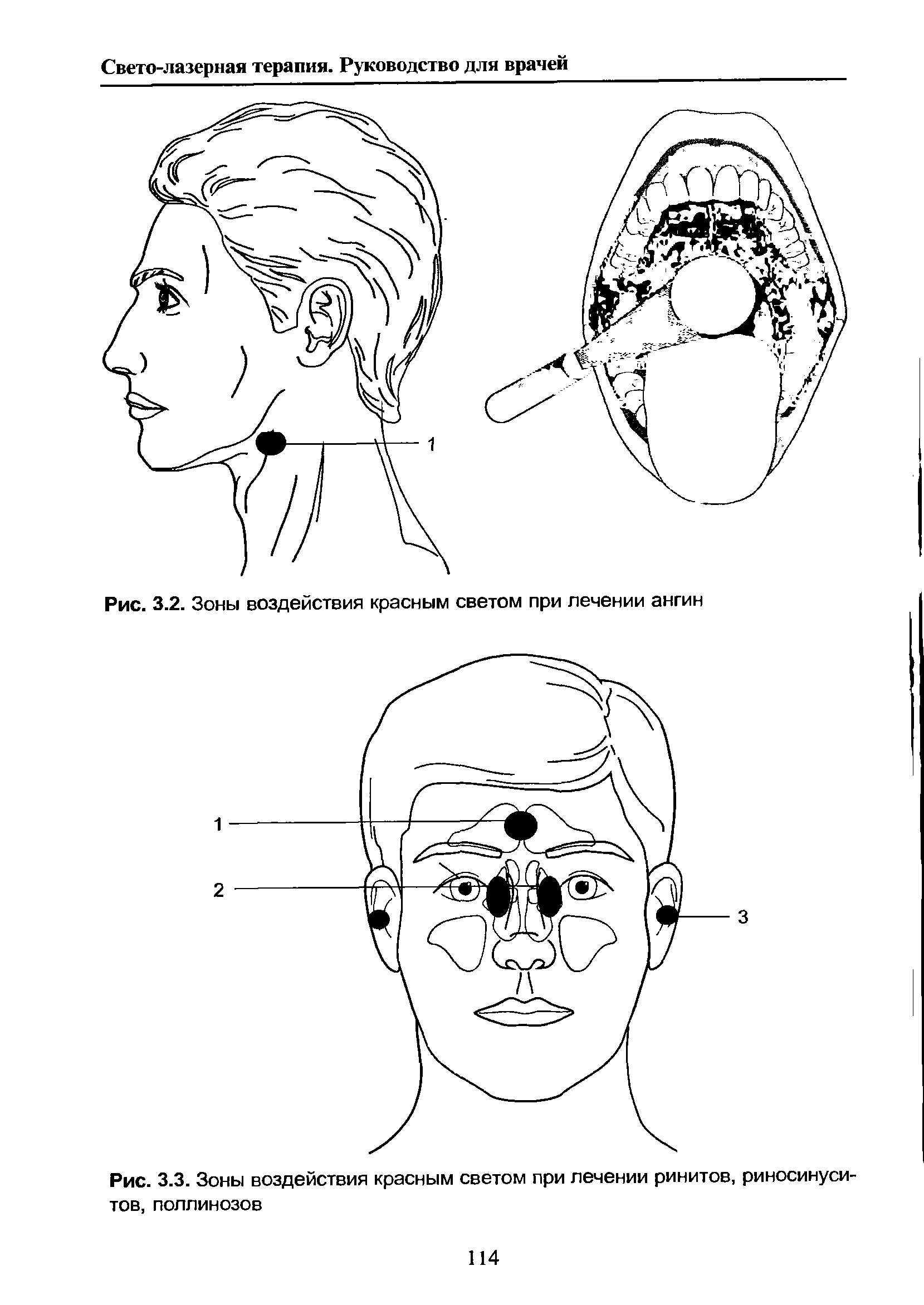 Рис. 3.3. Зоны воздействия красным светом при лечении ринитов, риносинуси-тов, поллинозов...