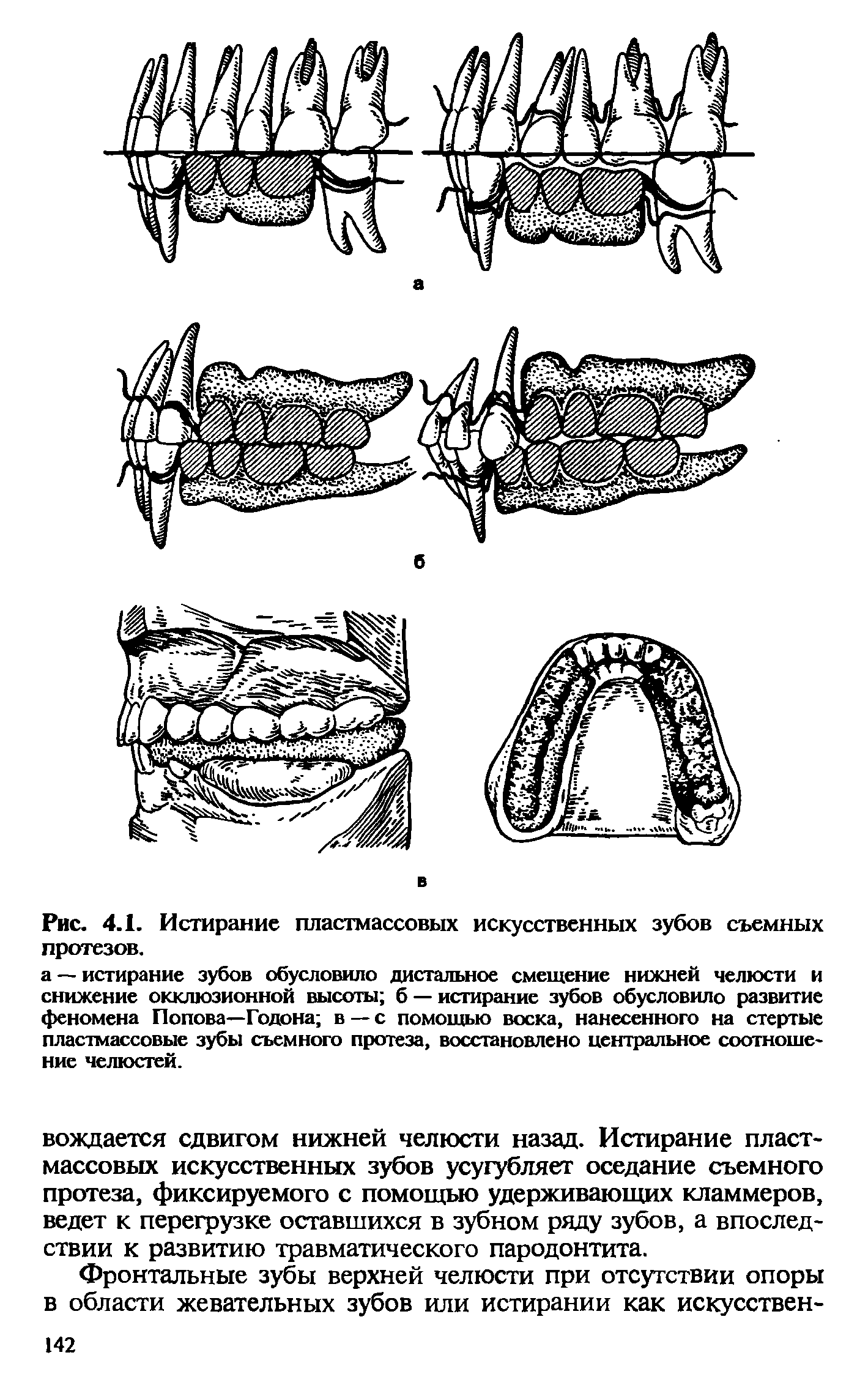 Рис. 4.1. Истирание пластмассовых искусственных зубов съемных протезов.