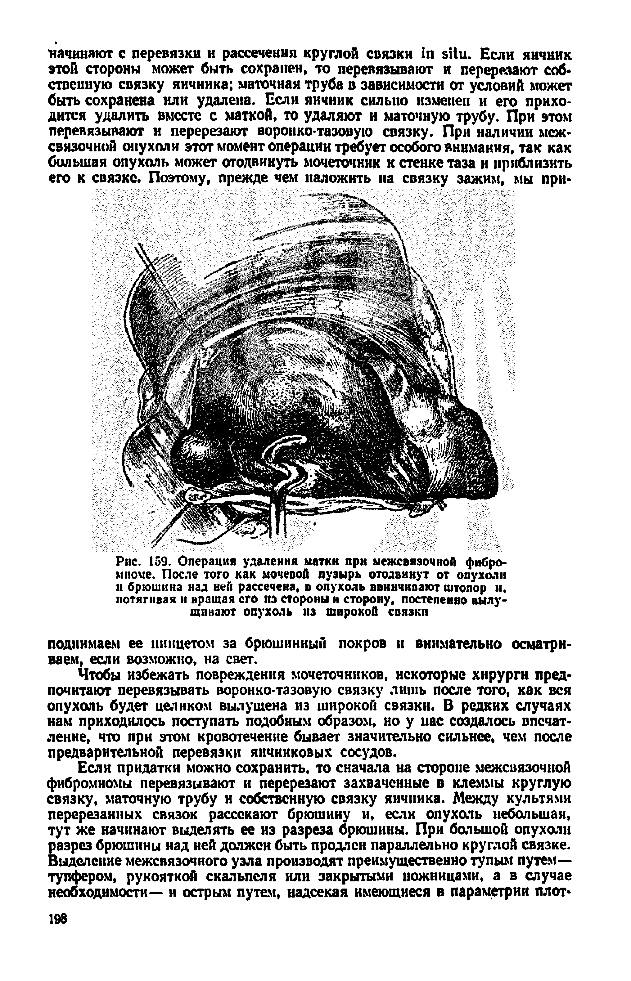 Рис. 159. Операция удаления матки при межсвязочной фибромиоме. После того как мочевой пузырь отодвинут от опухоли и брюшина над ней рассечена, в опухоль ввинчивают штопор и. потягивая и вращая его нз стороны н сторону, постепенно вылущивают опухоль нз широкой связки...