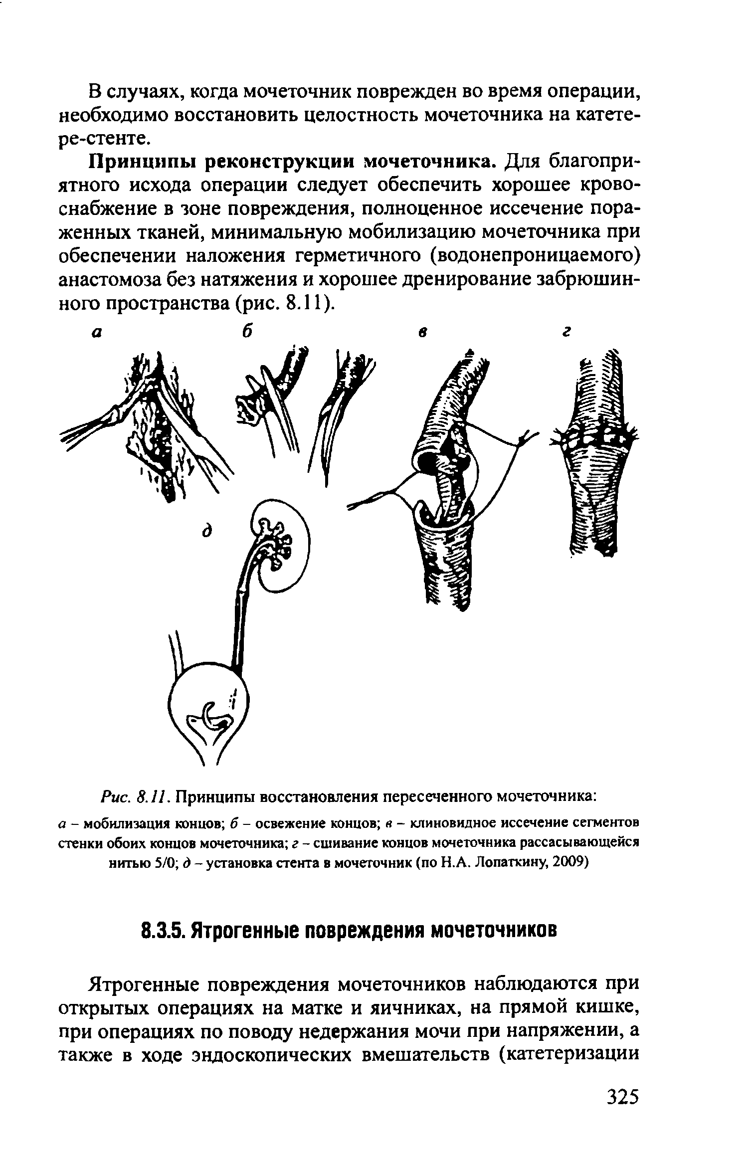 Рис. 8.11. Принципы восстановления пересеченного мочеточника а - мобилизация концов б - освежение концов а - клиновидное иссечение сегментов стенки обоих концов мочеточника г - сшивание концов мочеточника рассасывающейся нитью 5/0 д - установка стента в мочеточник (по Н.А. Лопаткину, 2009)...