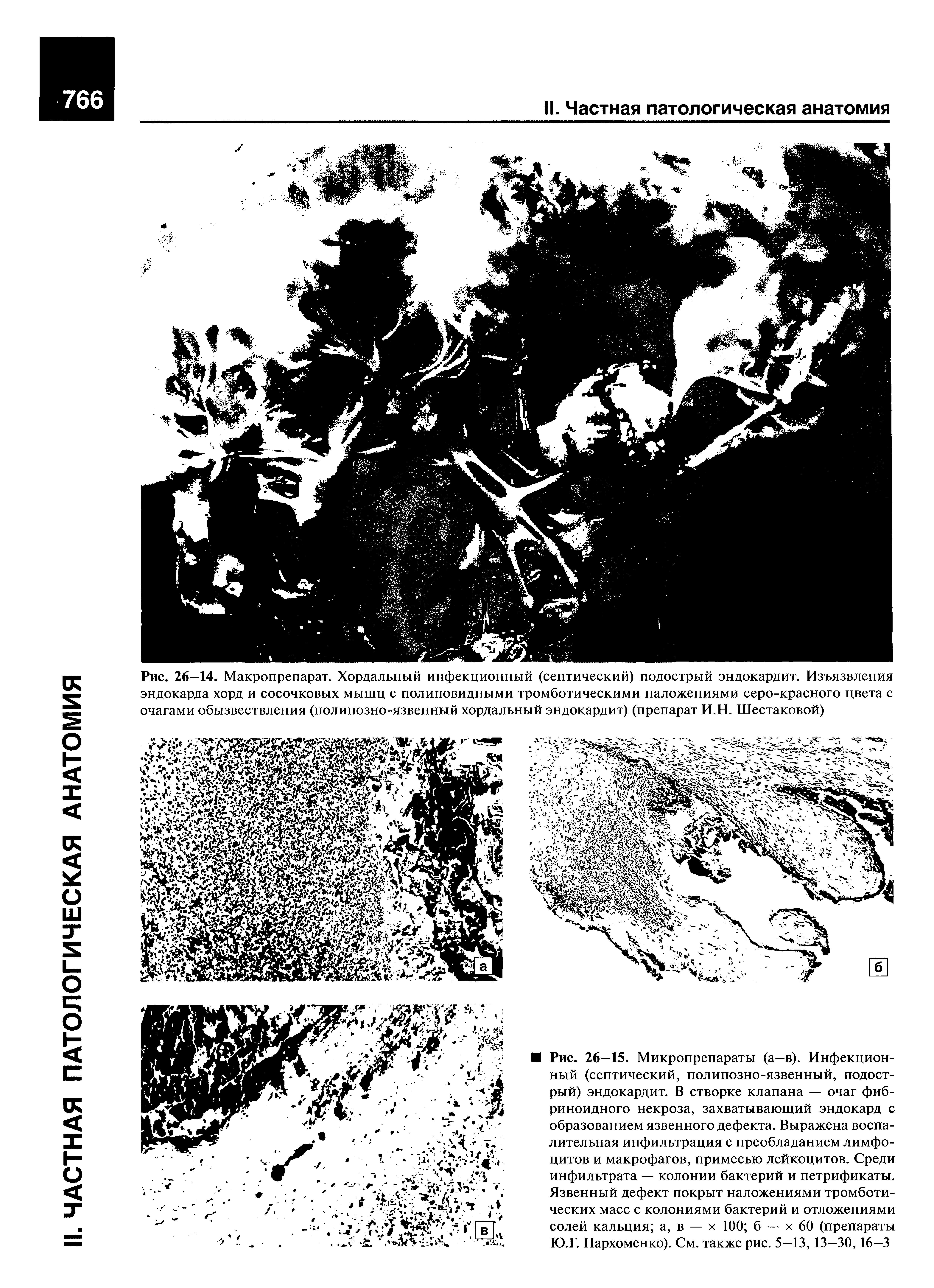 Рис. 26—14. Макропрепарат. Хордальный инфекционный (септический) подострый эндокардит. Изъязвления эндокарда хорд и сосочковых мышц с полиповидными тромботическими наложениями серо-красного цвета с очагами обызвествления (полипозно-язвенный хордальный эндокардит) (препарат И.Н. Шестаковой)...