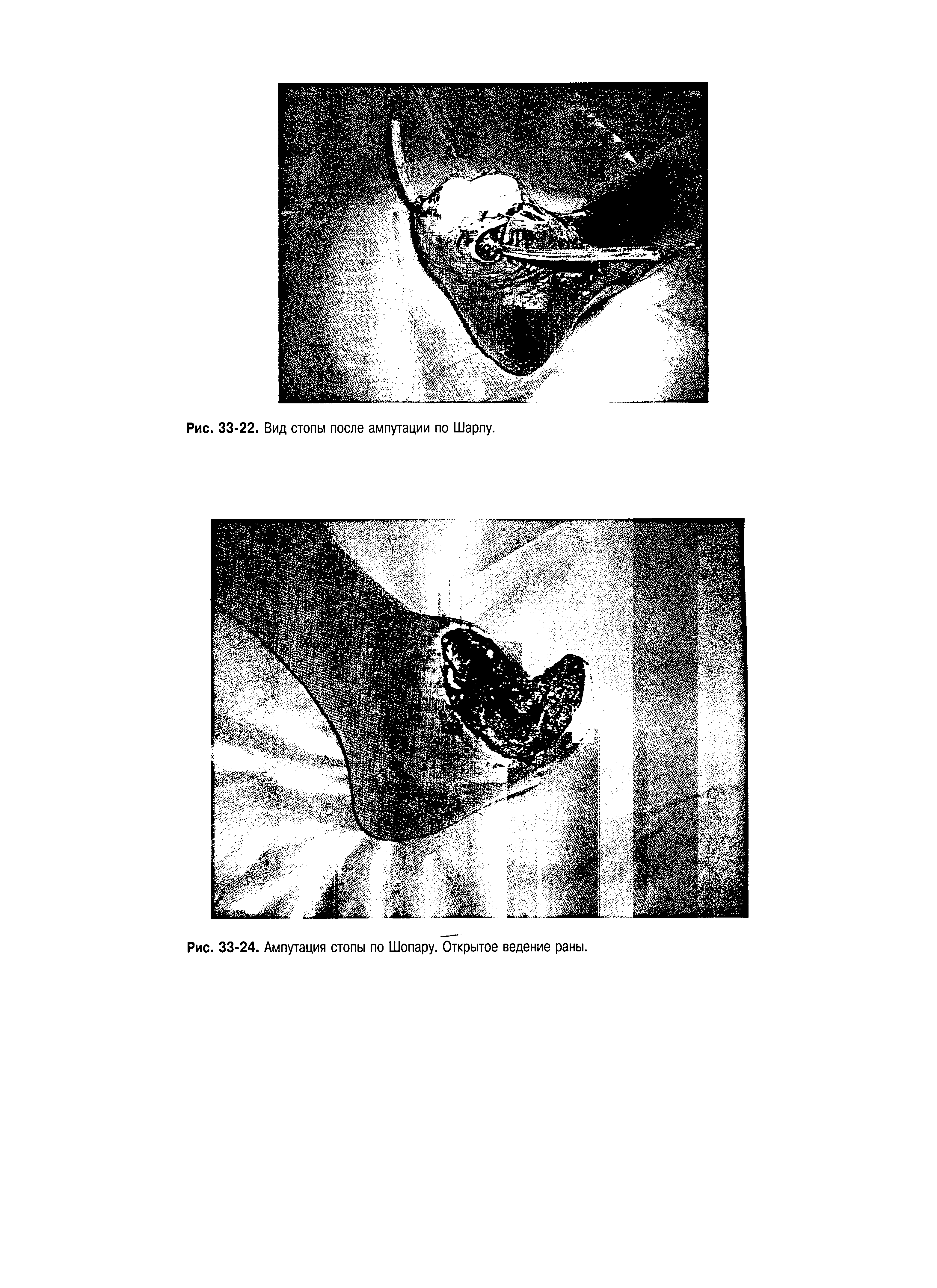 Рис. 33-24. Ампутация стопы по Шопару. Открытое ведение раны.