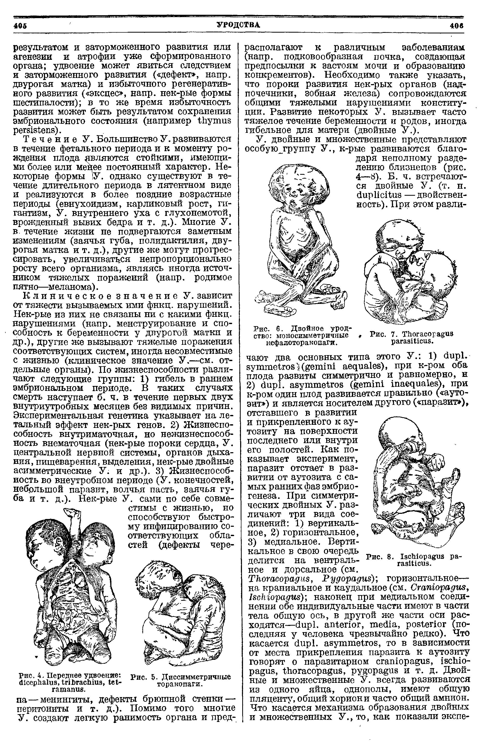 Рис. 4. Переднее удвоение рис. 5. Диссимметричные (НсерлаДиз, 1г1Ьгясишз ДсД- торакопаги...