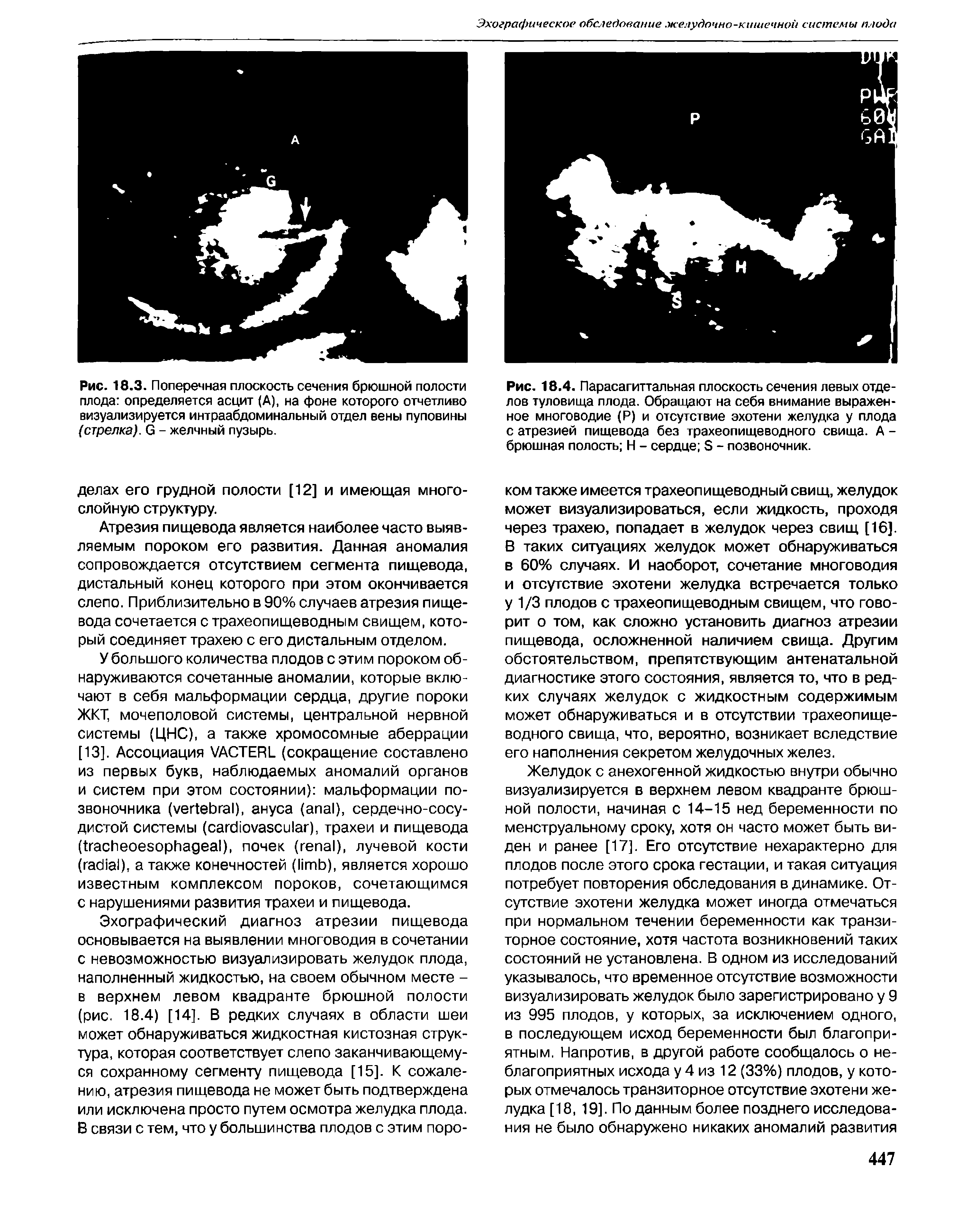 Рис. 18.4. Парасагиттальная плоскость сечения левых отделов туловища плода. Обращают на себя внимание выраженное многоводие (Р) и отсутствие эхотени желудка у плода с атрезией пищевода без трахеопищеводного свища. А -брюшная полость Н - сердце Б - позвоночник.