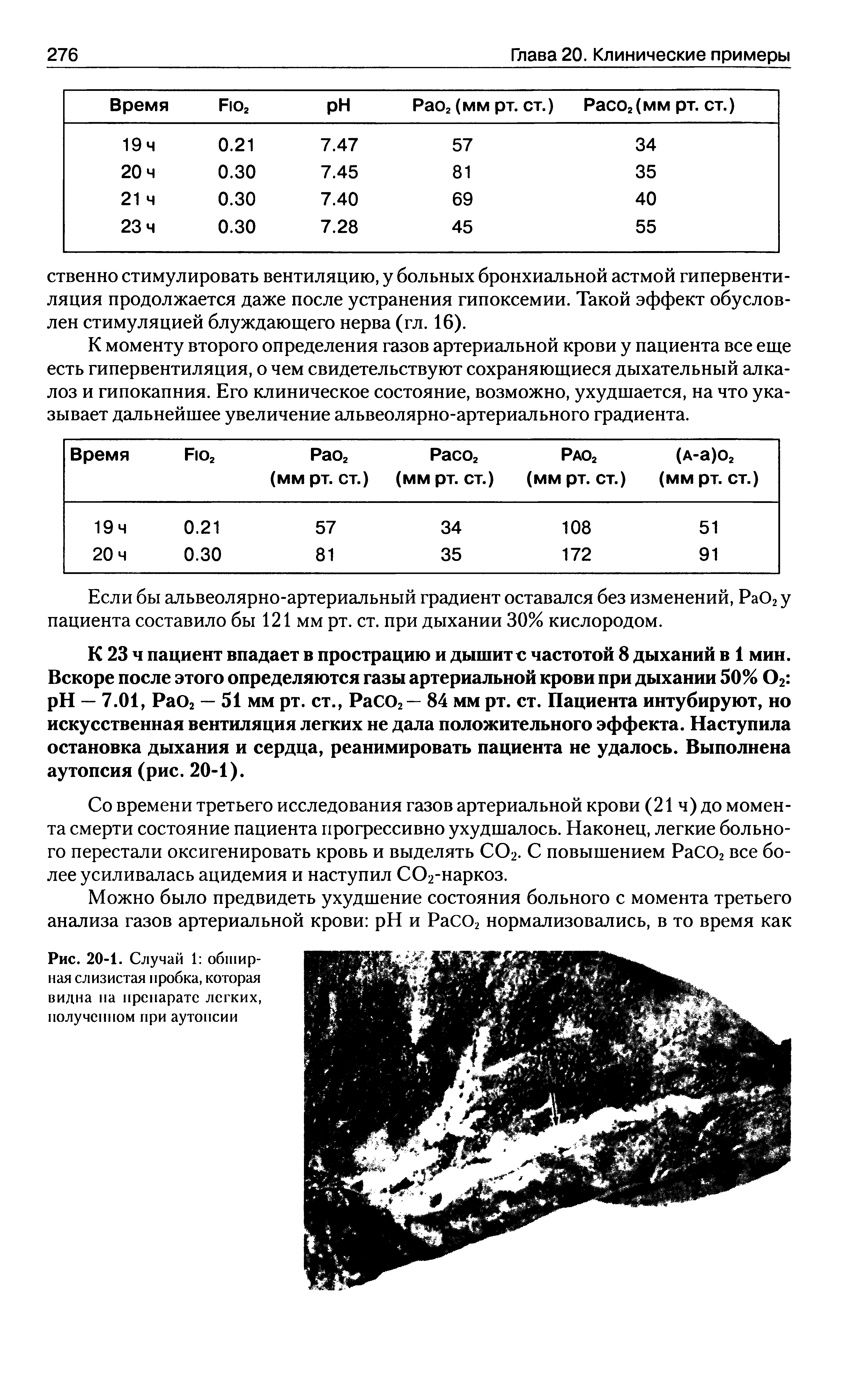 Рис. 20-1. Случай 1 обширная слизистая пробка, которая видна на препарате легких, полученном при аутопсии...