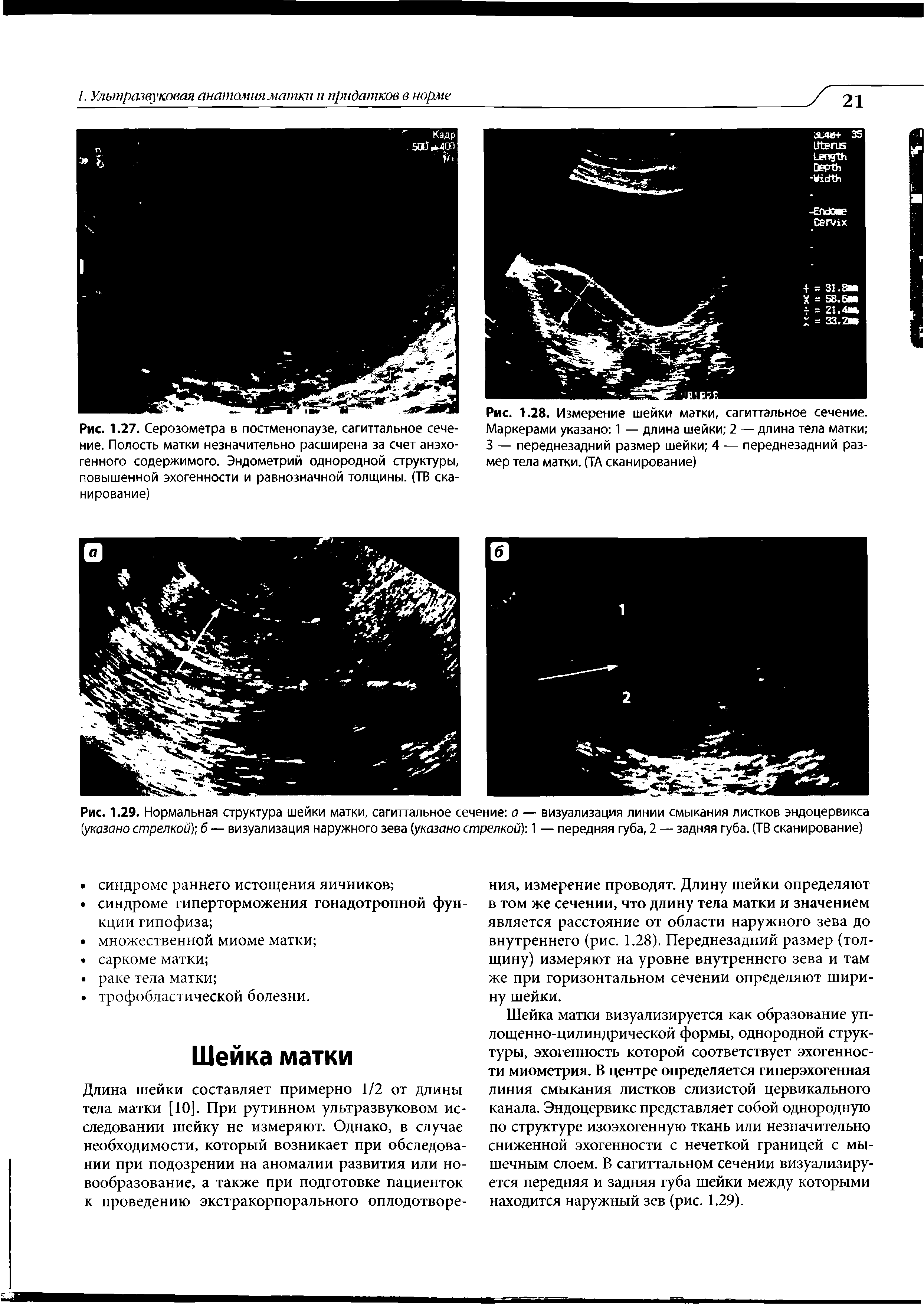 Рис. 1.28. Измерение шейки матки, сагиттальное сечение. Маркерами указано 1 — длина шейки 2 — длина тела матки 3 — переднезадний размер шейки 4 — переднезадний размер тела матки. (ТА сканирование)...