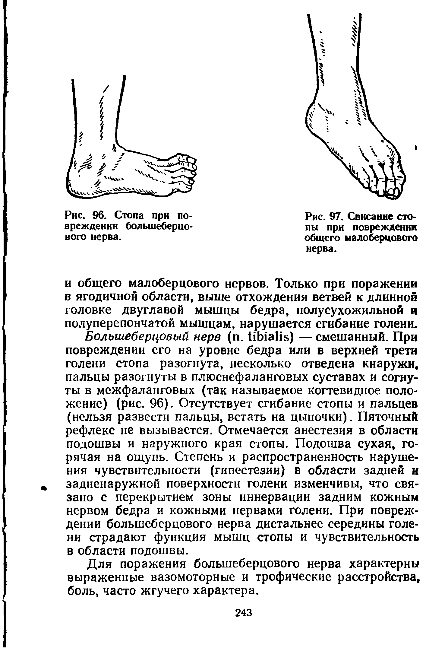 Рис. 97. Свисание стопы при повреждении общего малоберцового нерва.