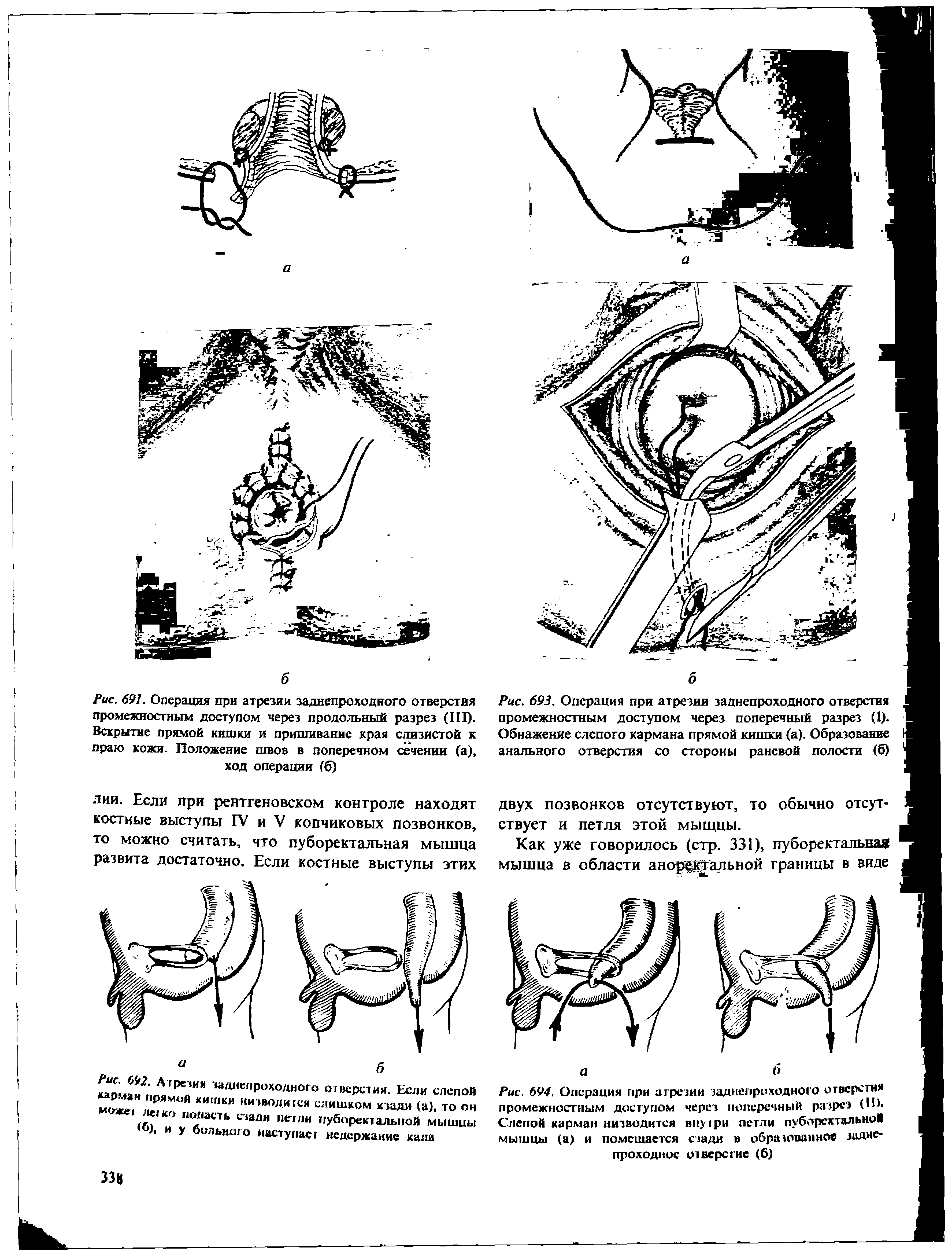 Рис. 694. Операция при а грезим заднепроходного отверстия промежностным доступом через поперечный разрез (ПК Слепой карман низводится внутри петли пуборетстальноЙ мышцы (а) и помещается сзади в образованное заднепроходное о1 верегне (6)...