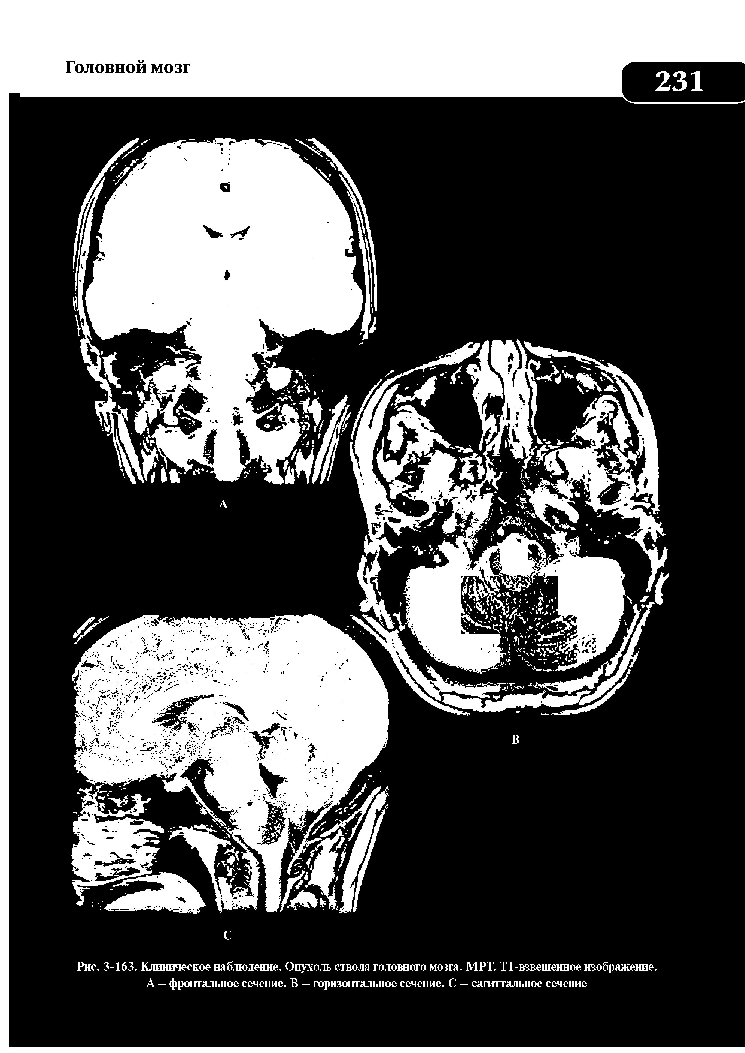 Рис. 3-163. Клиническое наблюдение. Опухоль ствола головного мозга. МРТ. Т1-взвешенное изображение. А — фронтальное сечение. В — горизонтальное сечение. С — сагиттальное сечение...