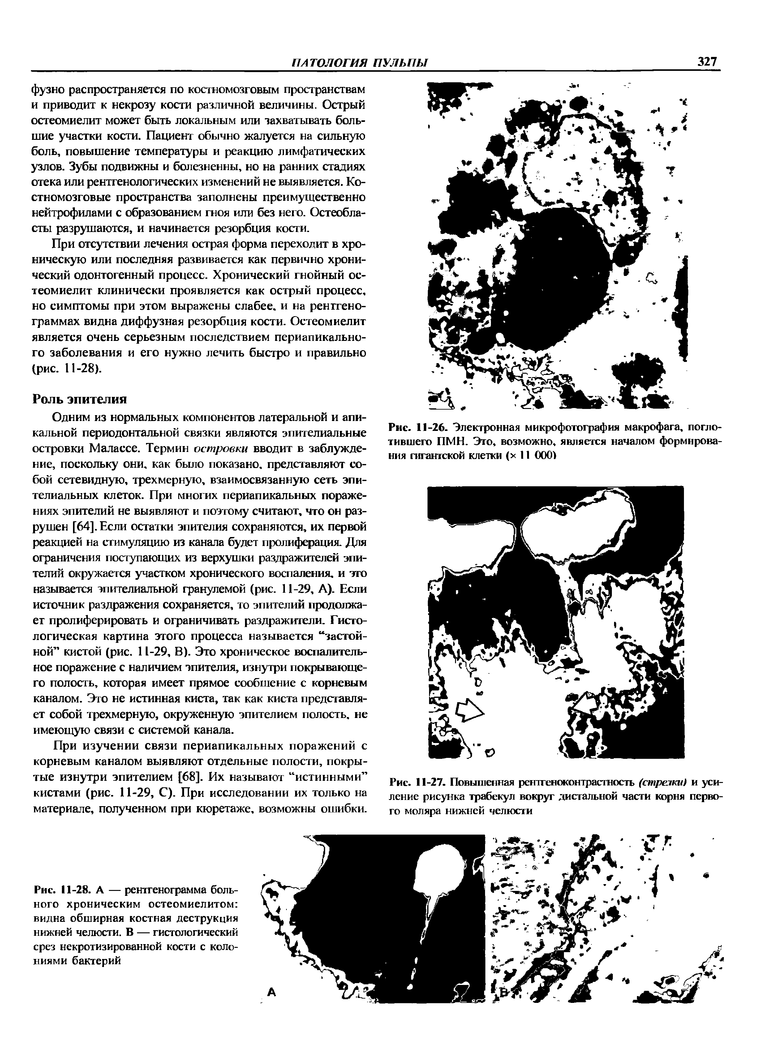 Рис. 11-28. А — рентгенограмма больного хроническим остеомиелитом видна обширная костная деструкция нижней челюсти. В — гистологический срез некротизированной кости с колониями бактерий...