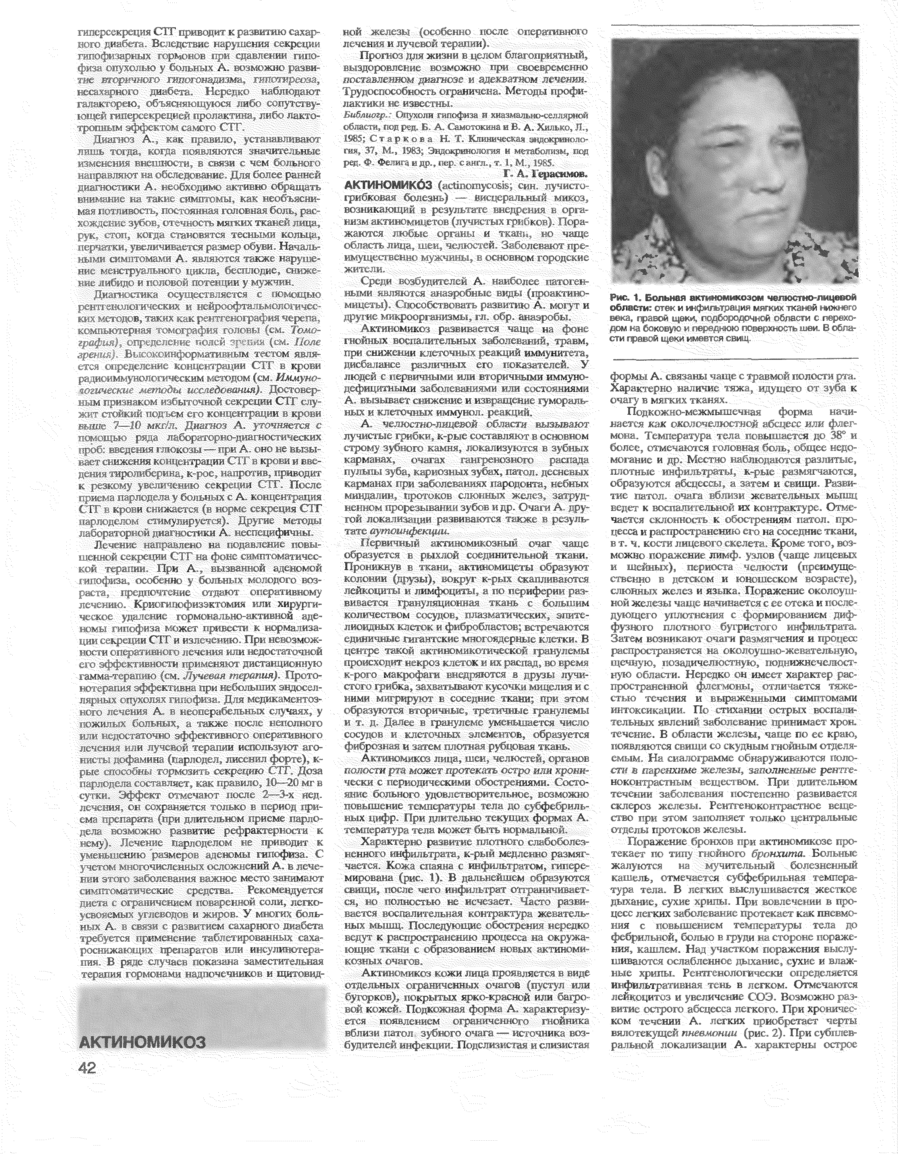 Рис. 1. Больная актиномикозом челкхлно-лицевой области отек и инфильтрация мягких тканей нижнего века, правой щеки, гюдбородрчной рбласти с переходом на < к 4 пеоеднки 1/еы л, г - > и г. < и-сти правой с. / м имеется сыи...