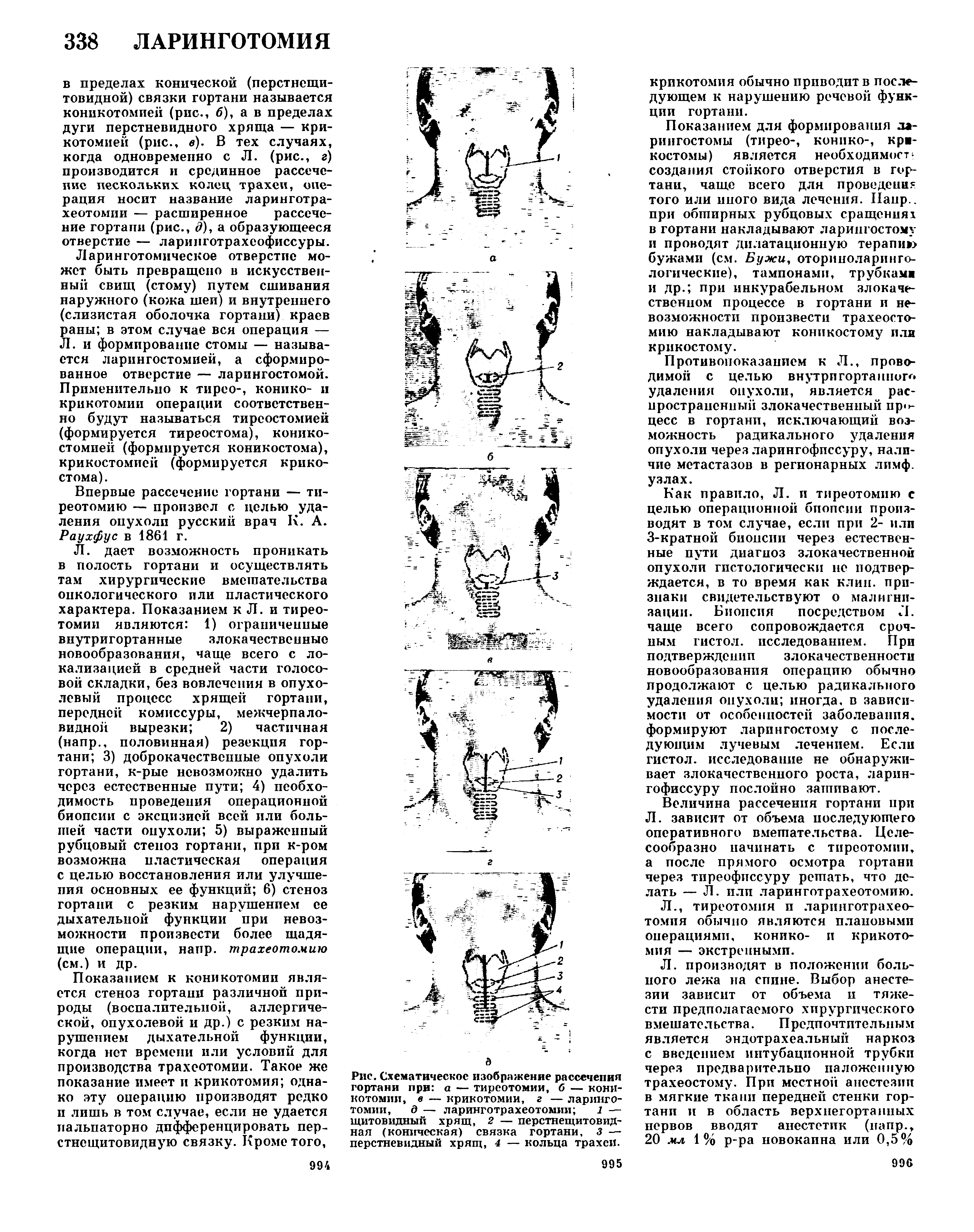 Рис. Схематическое изображение рассечения гортани при а — тиреотомии, б — коникотомии, в — крикотомии, г — ларинготомии, д — ларинготрахеотомии 1 — щитовидный хрящ, 2 — перстнещитовидная (коническая) связка гортани, 3 — перстневидный хрящ, 4 — кольца трахеи.