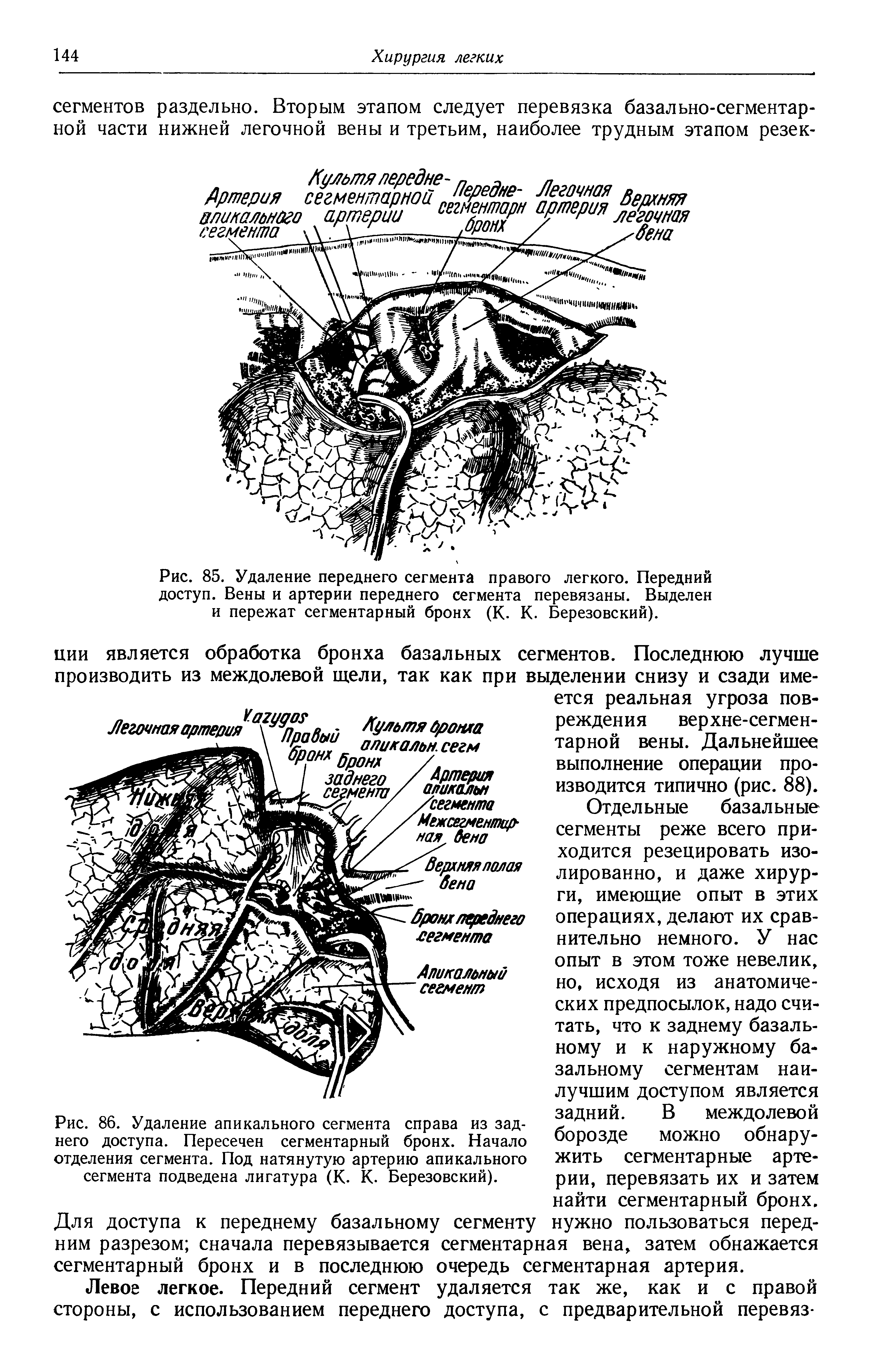 Рис. 85. Удаление переднего сегмента правого легкого. Передний доступ. Вены и артерии переднего сегмента перевязаны. Выделен и пережат сегментарный бронх (К. К. Березовский).