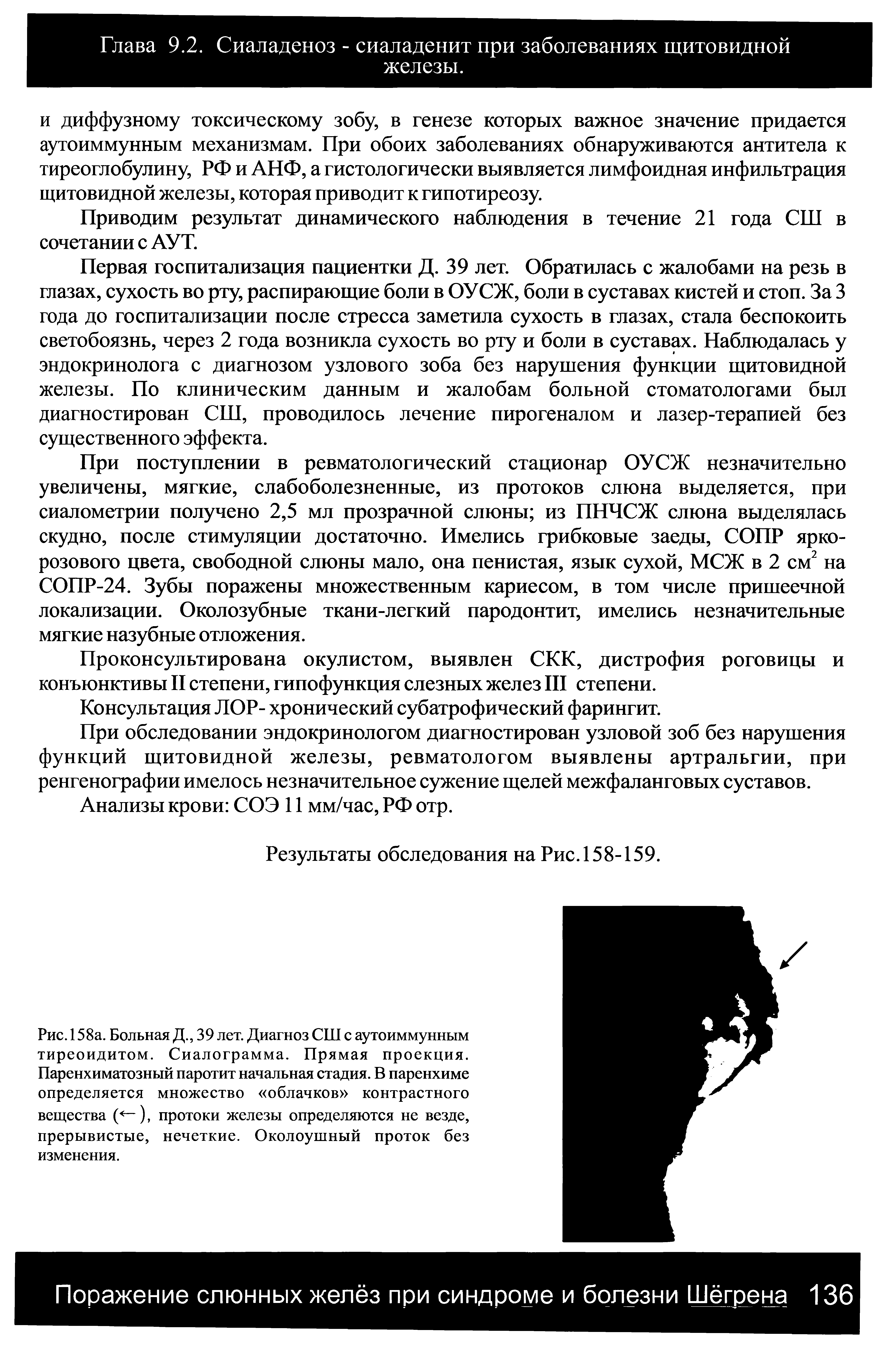 Рис. 158а. Больная Д., 39 лет. Диагноз СШ с аутоиммунным тиреоидитом. Сиалограмма. Прямая проекция. Паренхиматозный паротит начальная стадия. В паренхиме определяется множество облачков контрастного вещества ( -), протоки железы определяются не везде, прерывистые, нечеткие. Околоушный проток без изменения.