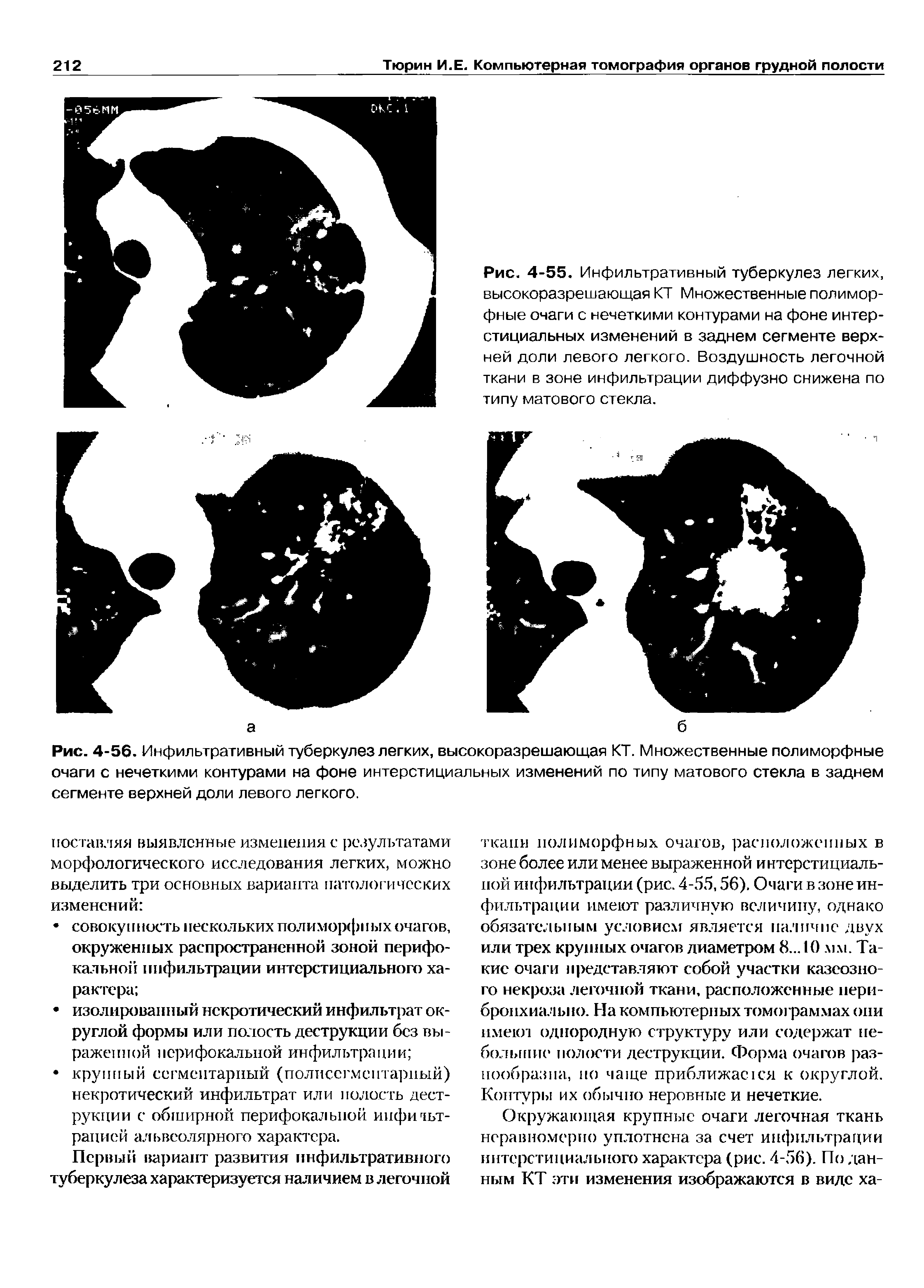 Рис. 4-56. Инфильтративный туберкулез легких, высокоразрешающая КТ. Множественные полиморфные очаги с нечеткими контурами на фоне интерстициальных изменений по типу матового стекла в заднем сегменте верхней доли левого легкого.