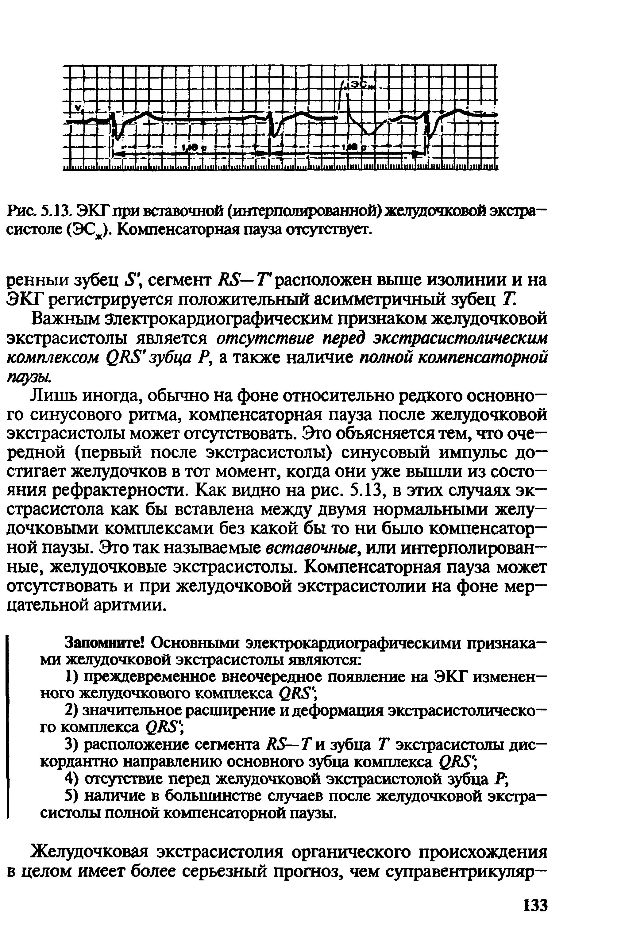 Рис. 5.13. ЭКГ при вставочной (интерполированной) желудочковой экстрасистоле (ЭСж). Компенсаторная пауза отсутствует.