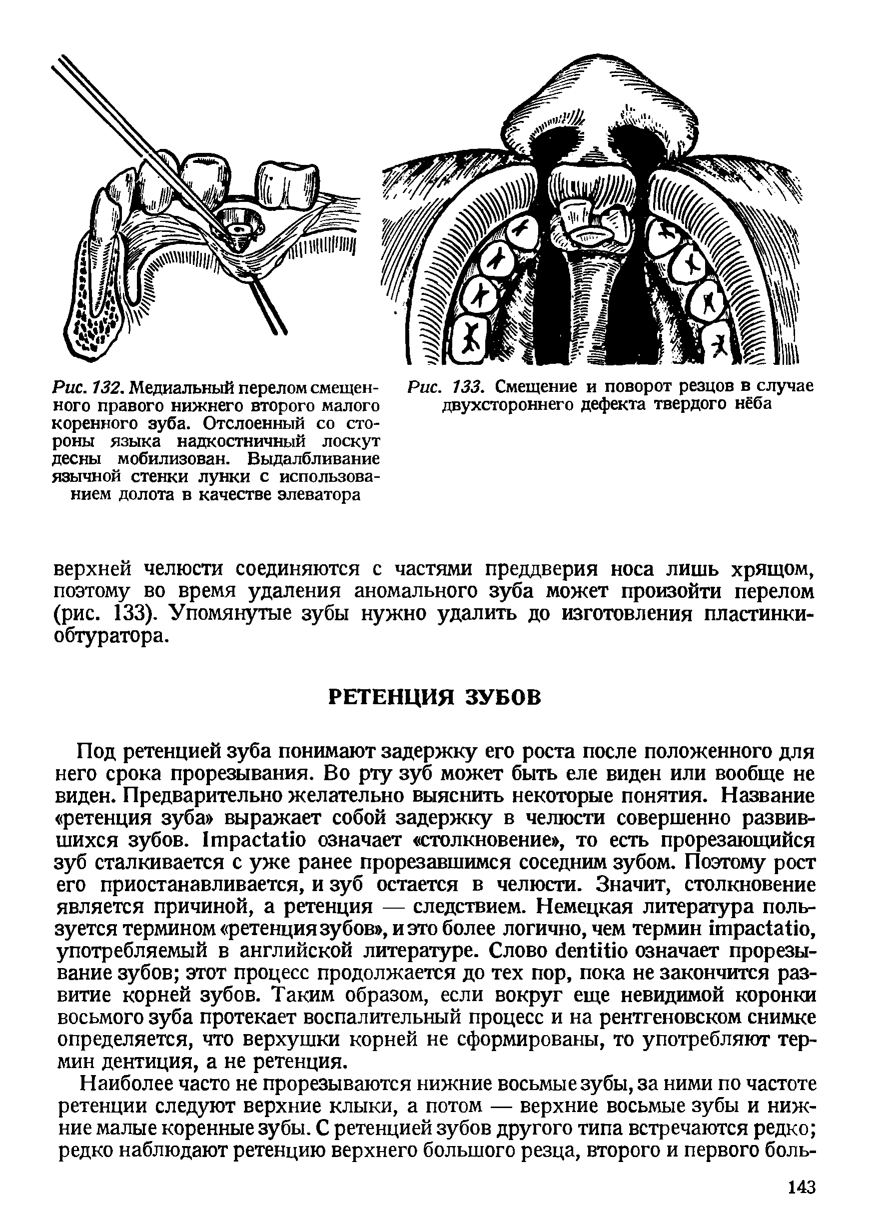 Рис. 132. Медиальный перелом смещенного правого нижнего второго малого коренного зуба. Отслоенный со стороны языка надкостничный лоскут десны мобилизован. Выдалбливание язычной стенки лунки с использованием долота в качестве элеватора...