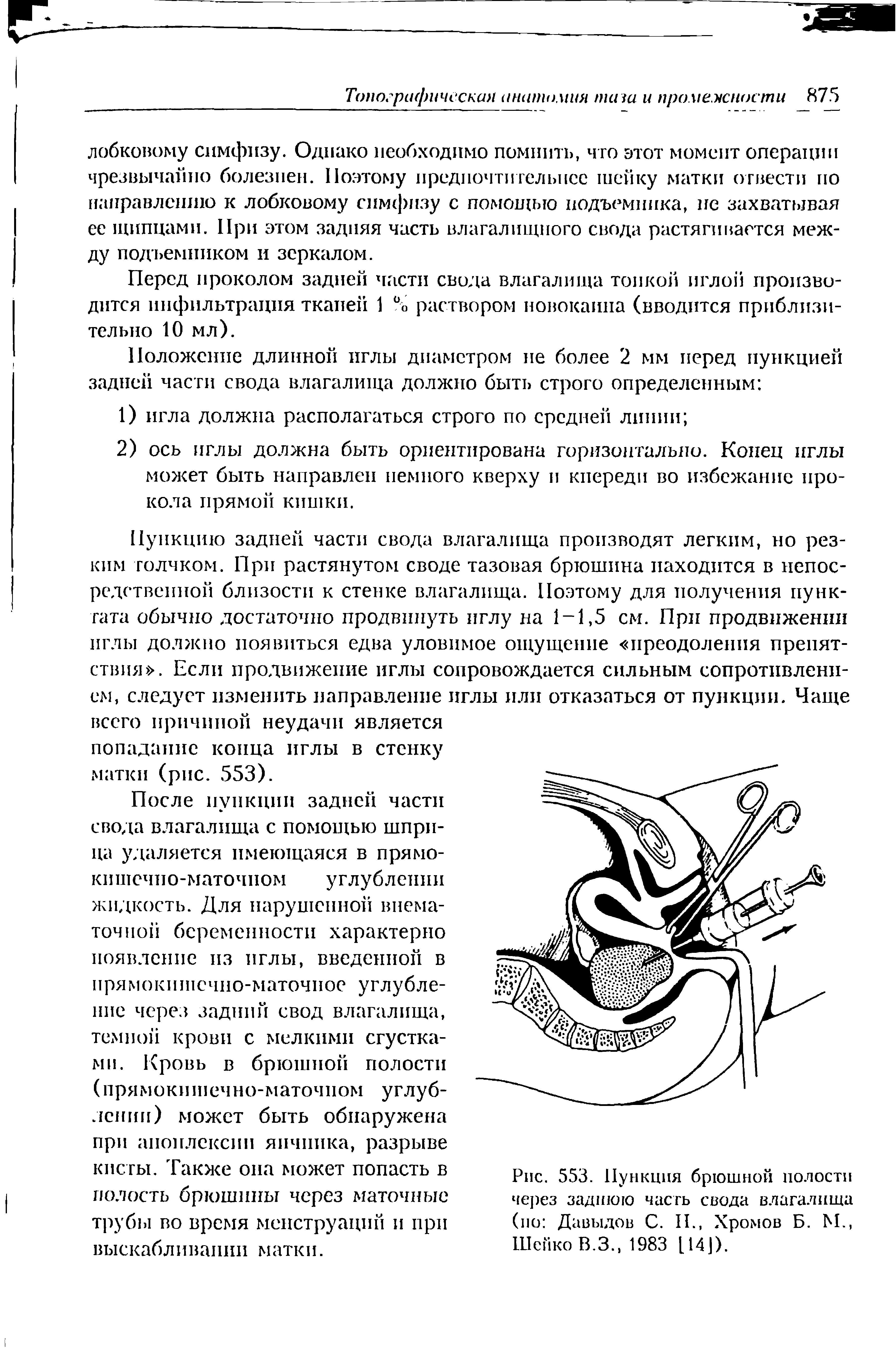 Рис. 553. Пункция брюшной полости через заднюю часть свода влагалища (ио Давыдов С. II., Хромов Б. М., ШейкоВ.З. 1983 [14]).