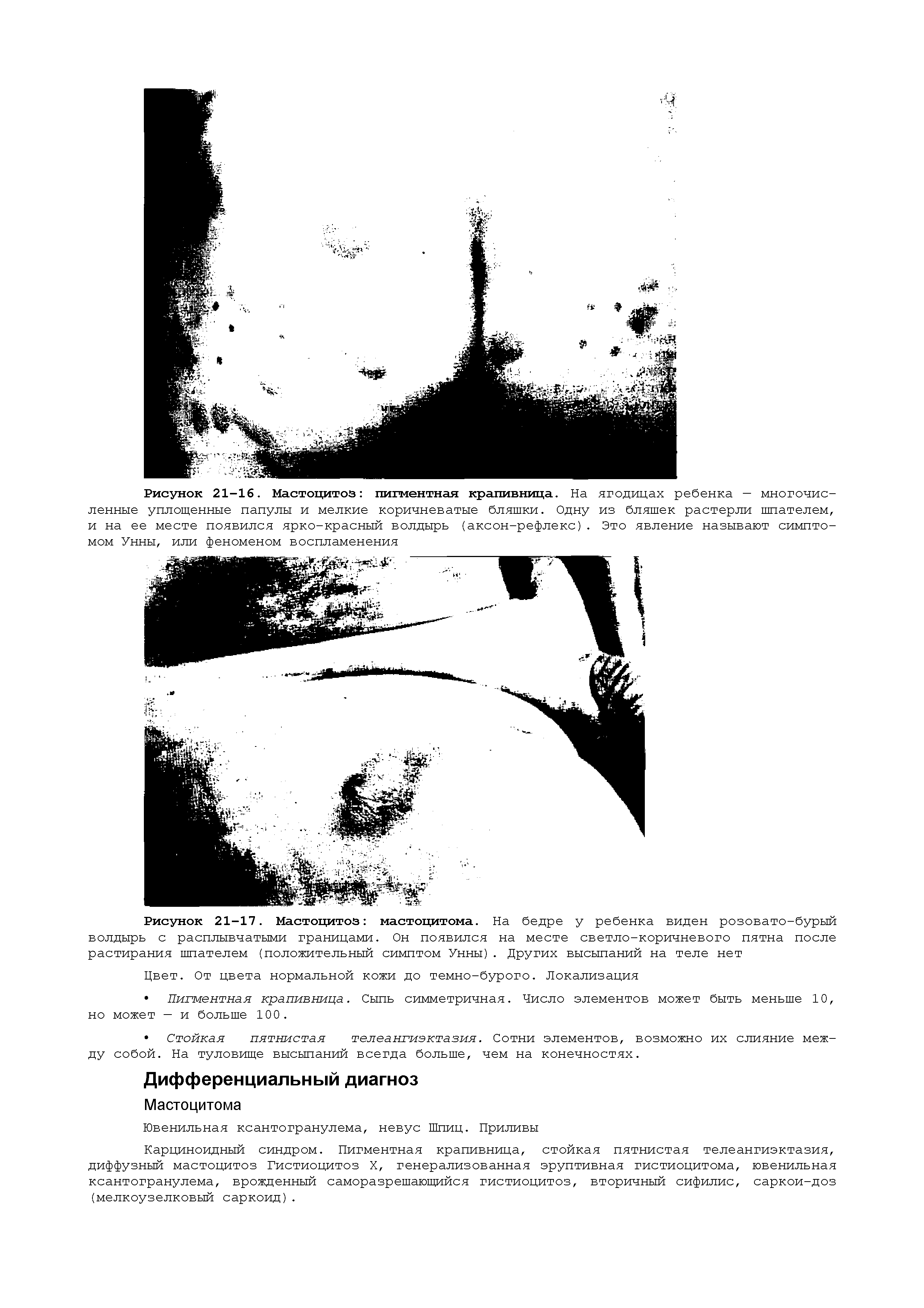 Рисунок 21-17. Мастоцитоз мастоцитома. На бедре у ребенка виден розовато-бурый волдырь с расплывчатыми границами. Он появился на месте светло-коричневого пятна после растирания шпателем (положительный симптом Унны). Других высыпаний на теле нет...