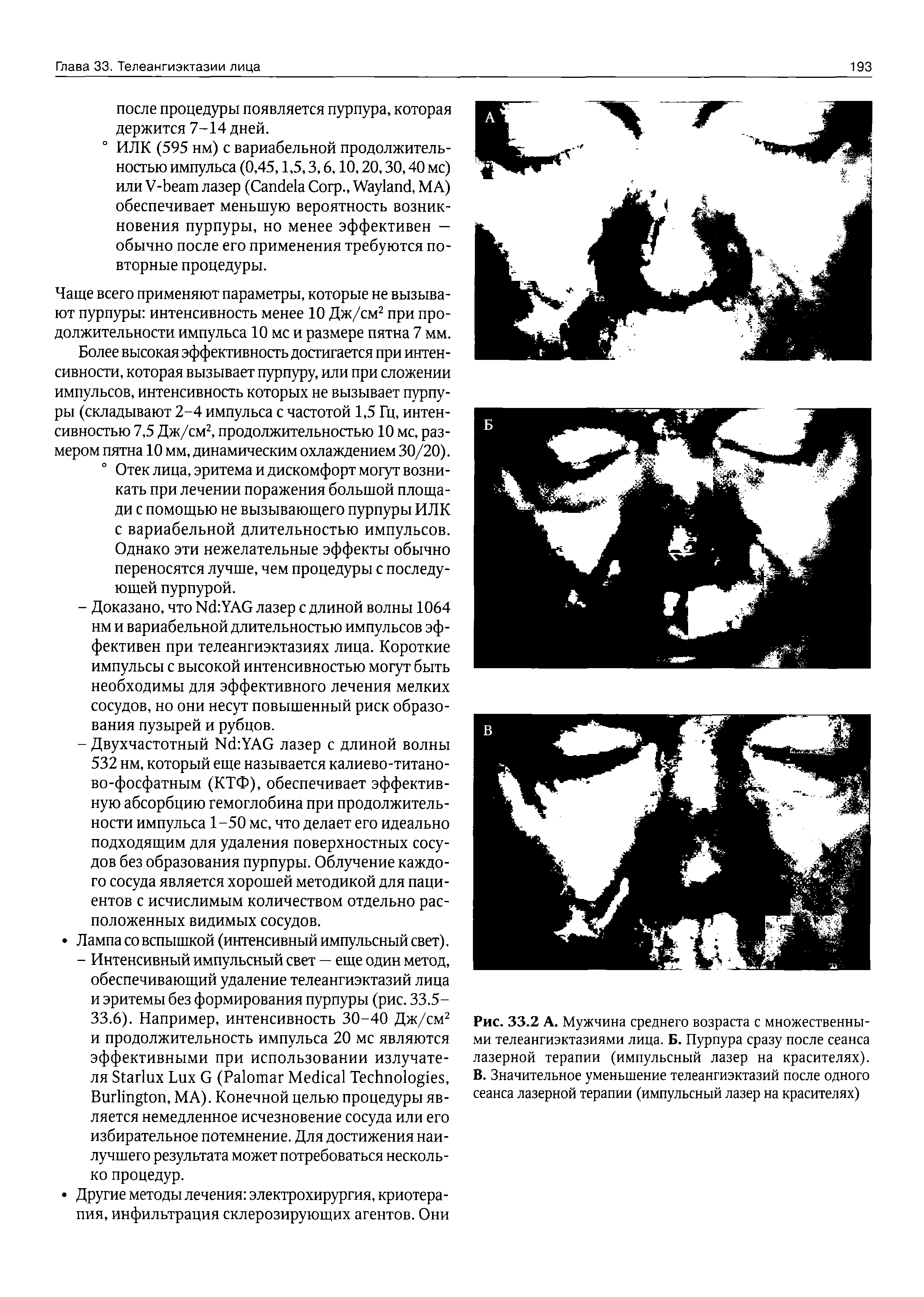 Рис. 33.2 А. Мужчина среднего возраста с множественными телеангиэктазиями лица. Б. Пурпура сразу после сеанса лазерной терапии (импульсный лазер на красителях). В. Значительное уменьшение телеангиэктазий после одного сеанса лазерной терапии (импульсный лазер на красителях)...
