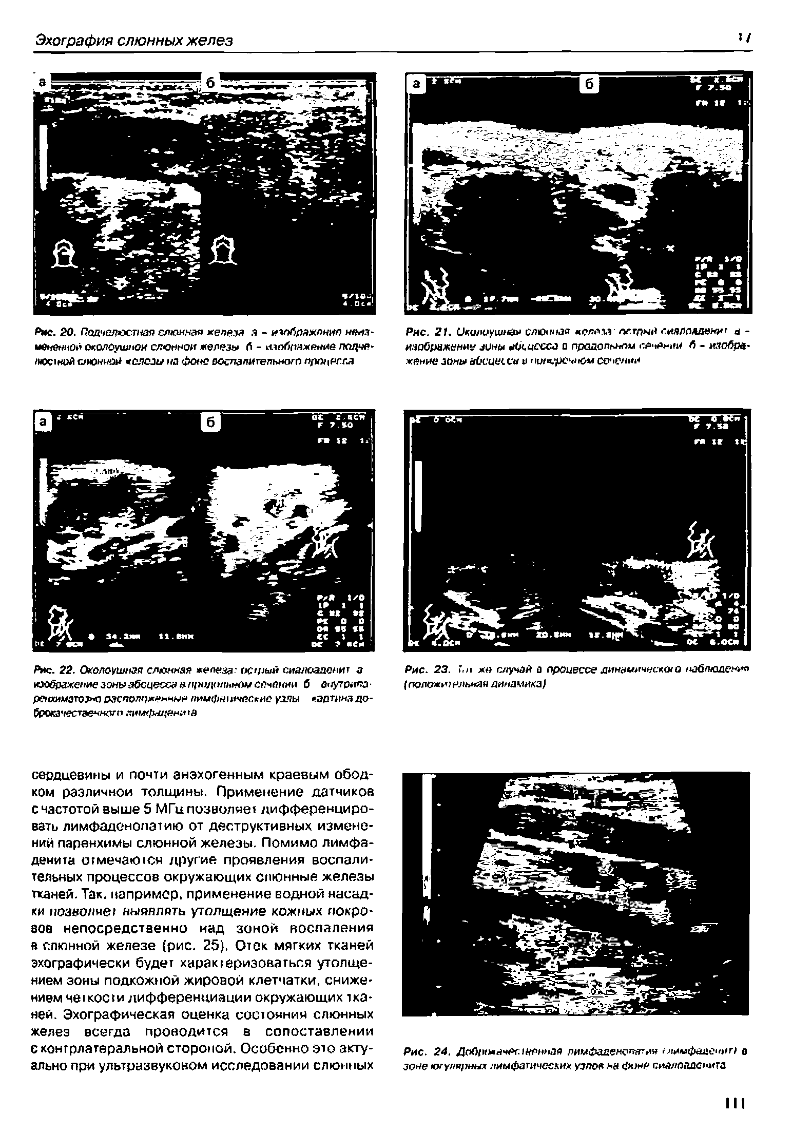 Рис. 22. Околоушная слюнная железа- острый сиалоаденит а изображение зонъ> абсцесса апродолнном сечении б онутрила -регоимзгозно расположенный тнифтничвг.кис узлы эртмнэ до-брокачественного лимфаденита...