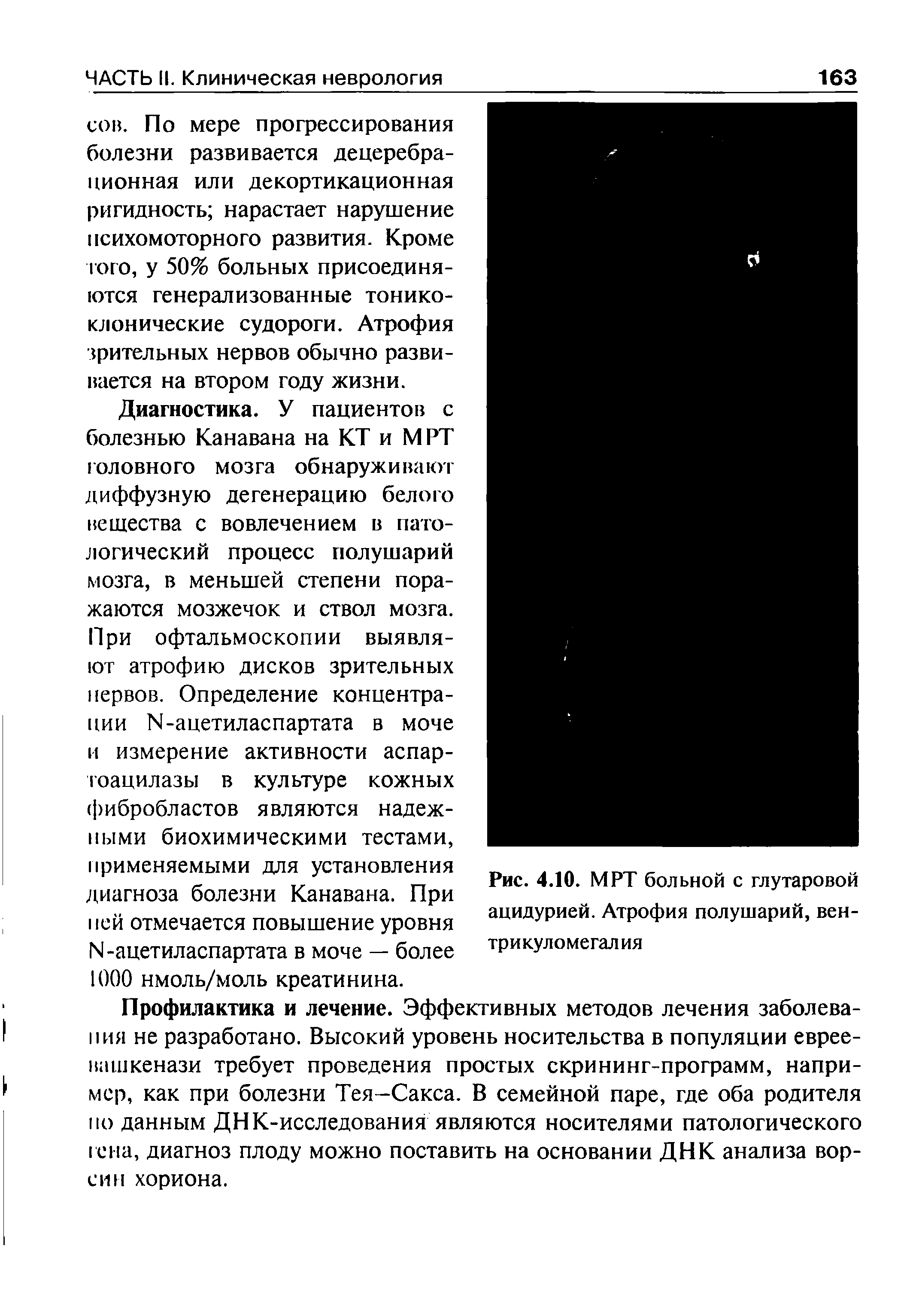 Рис. 4.10. МРТ больной с глутаровой ацидурией. Атрофия полушарий, вен-трикуломегалия...